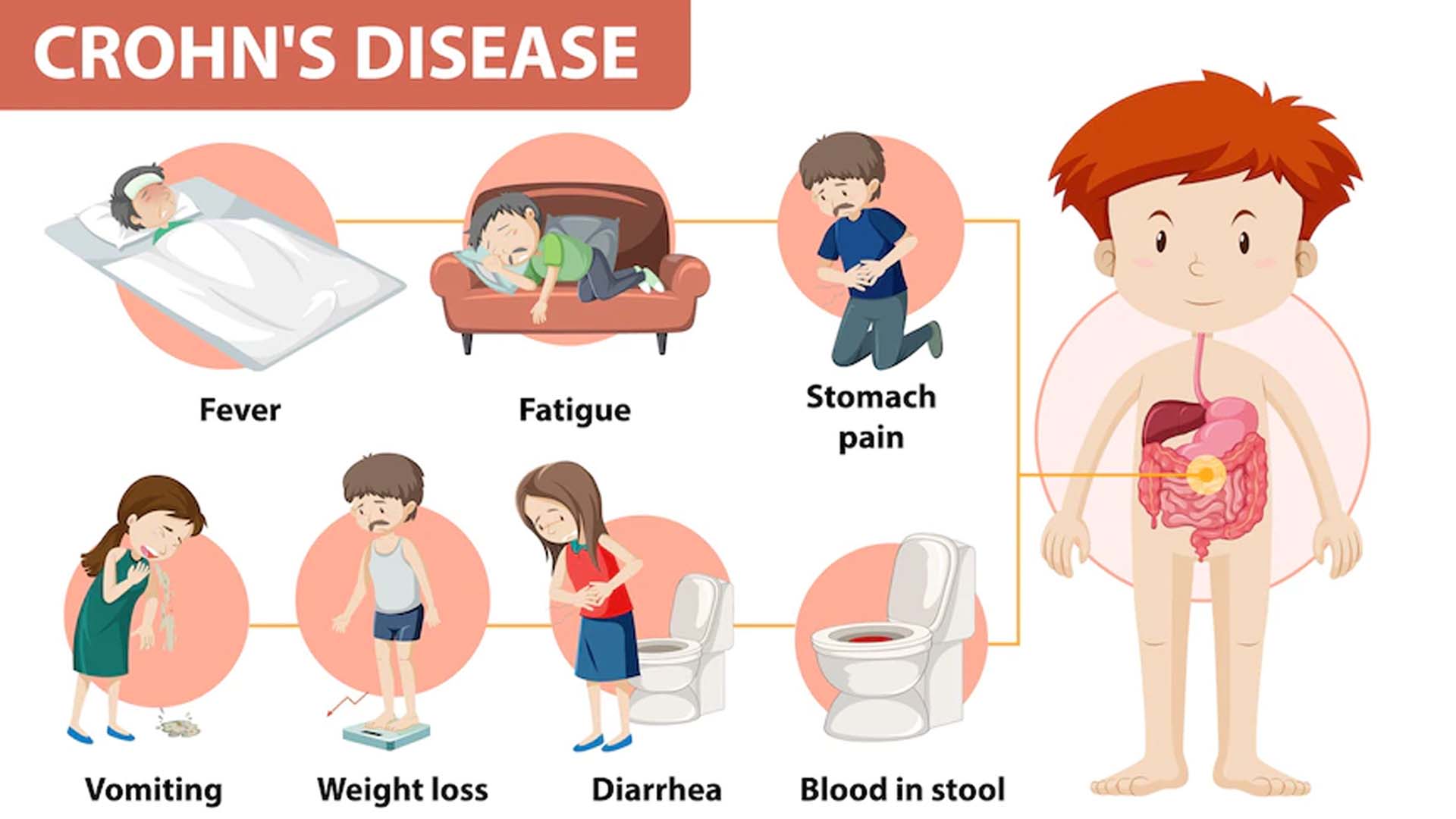 Crohn's Disease: Causes, Symptoms, Diagnosis and Treatment