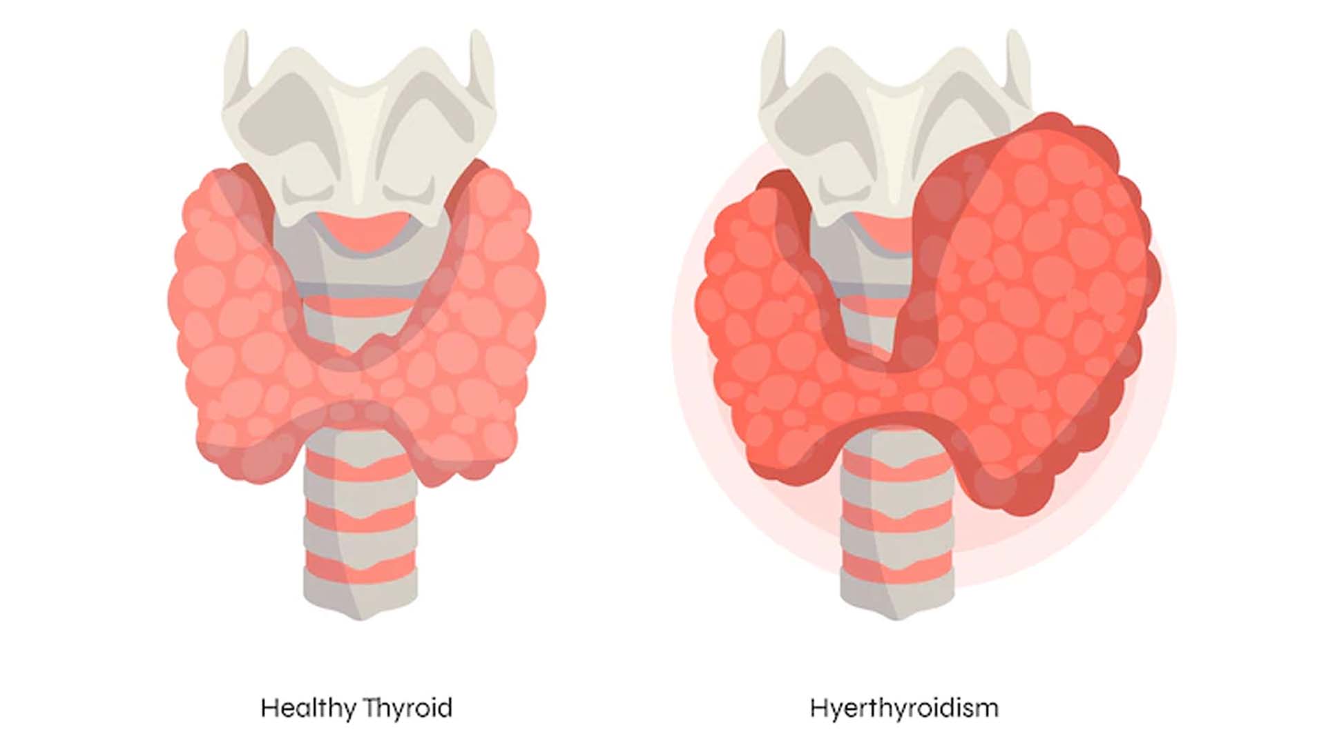 Hyperthyroidism: Causes, Symptoms and Treatment