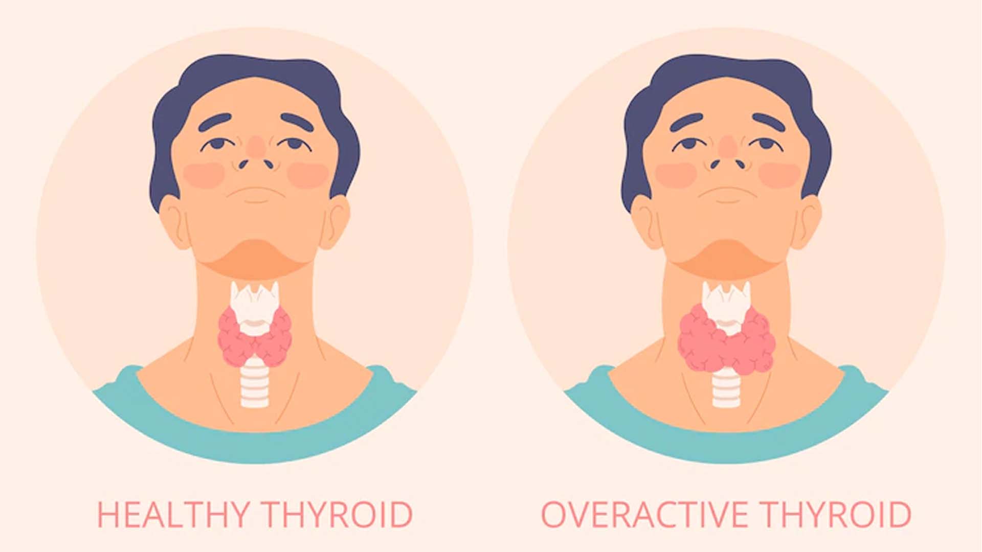 Thyroid: Causes, Symptoms, Diagnosis and treatment