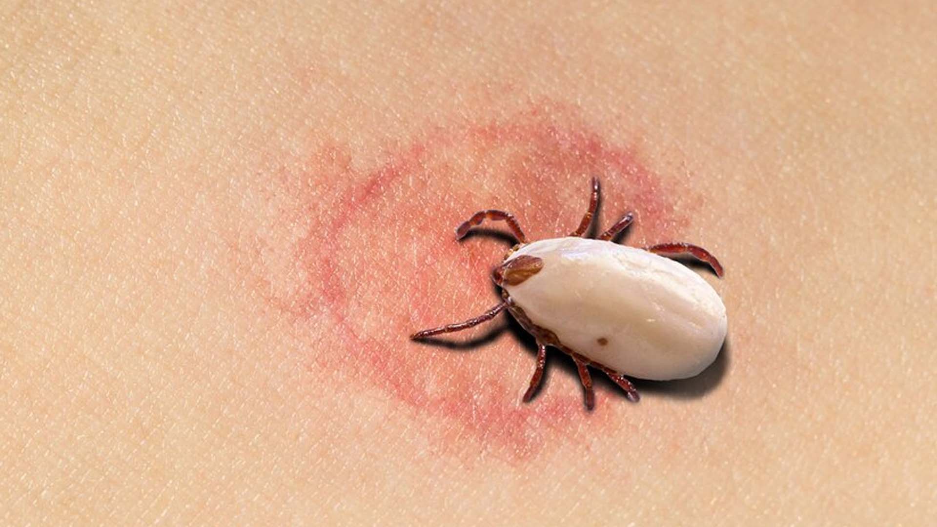 Lyme Disease: Symptoms, Causes, Treatments and Prevention