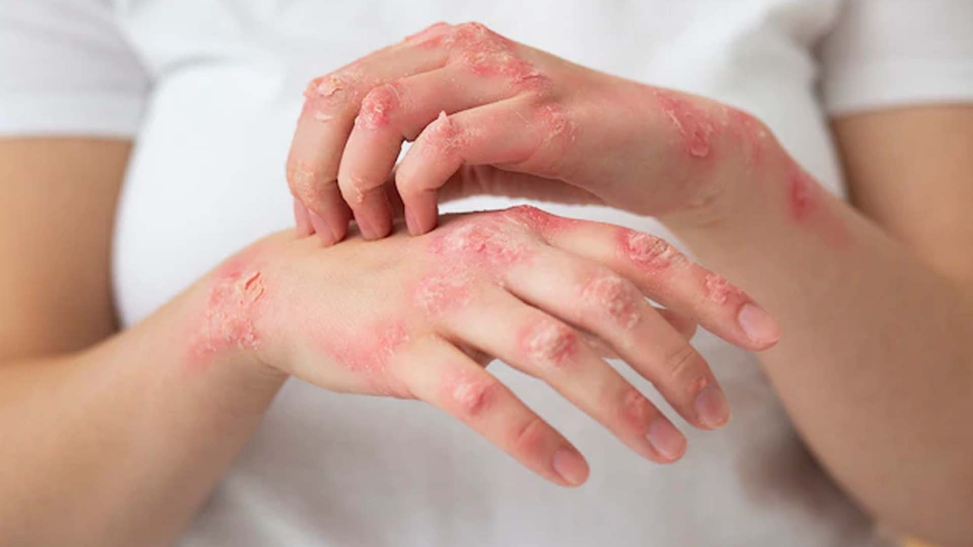 Skin Diseases: Types, Symptoms, Diagnosis, Treatment and Diet