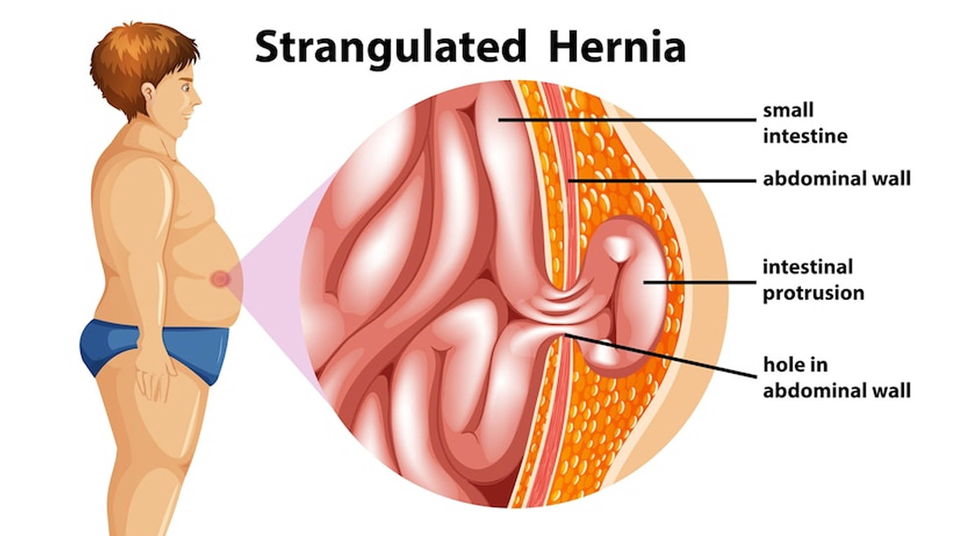 Hernia: Types, Symptoms, Causes, Risk Factors and Diet