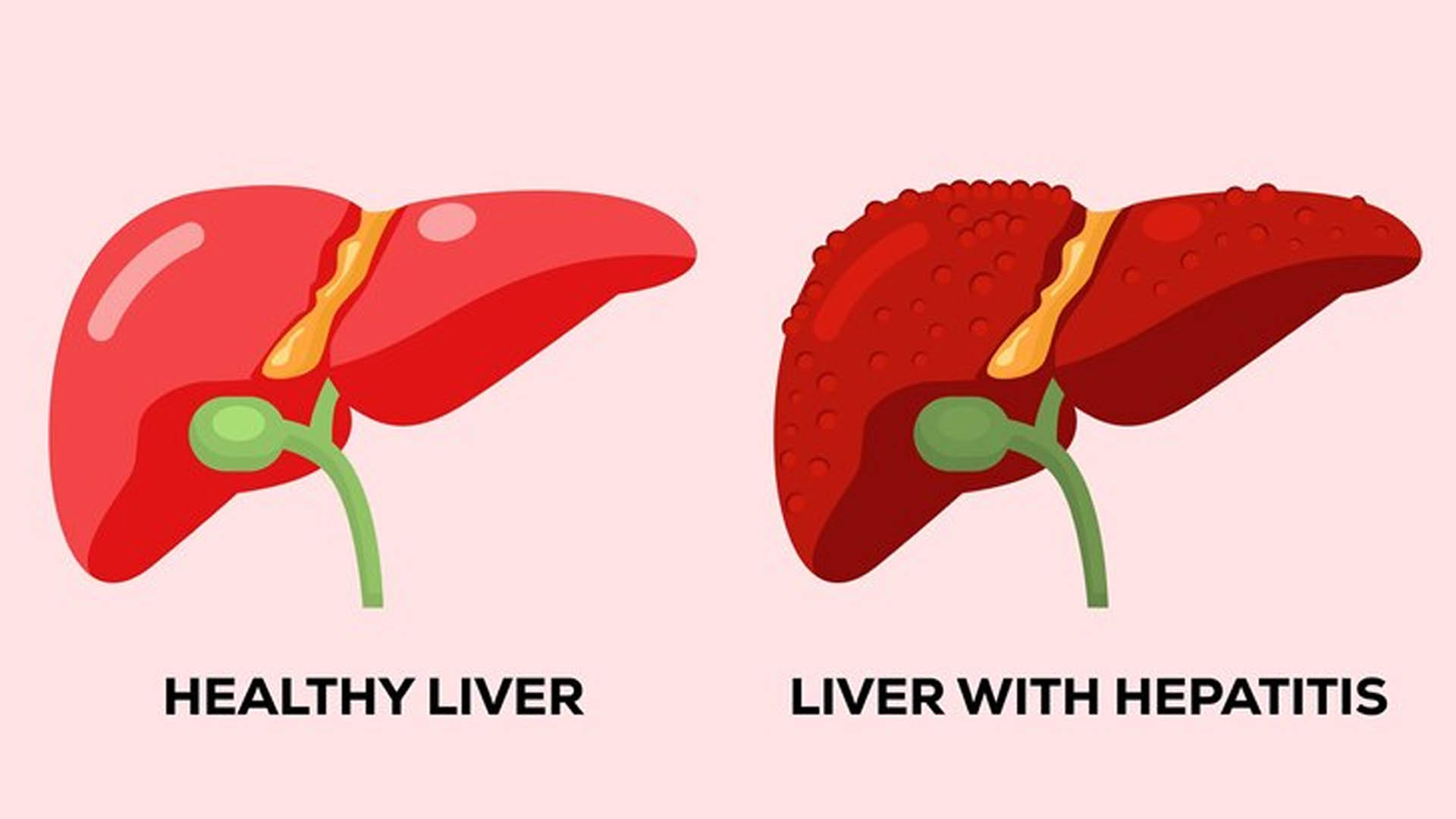 Liver Disease: Diagnosis, Treatment and Prevention