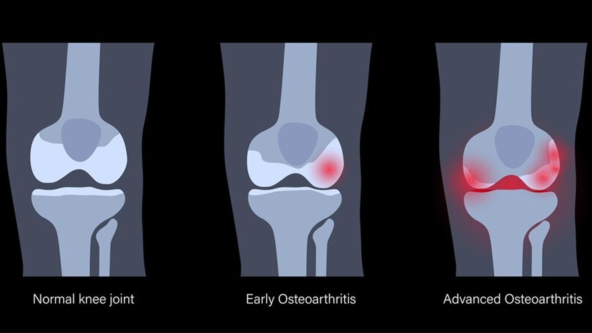 Osteoarthritis: Causes, Symptoms and Treatment