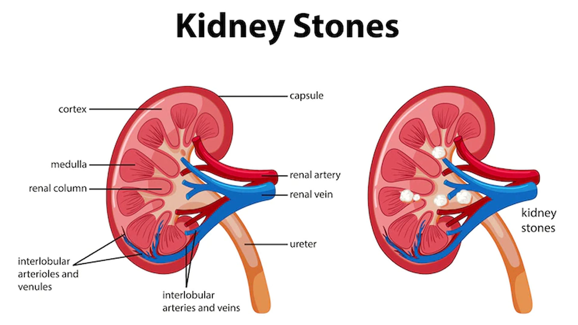 Kidney Stones: Causes, Symptoms, Treatment and Diet