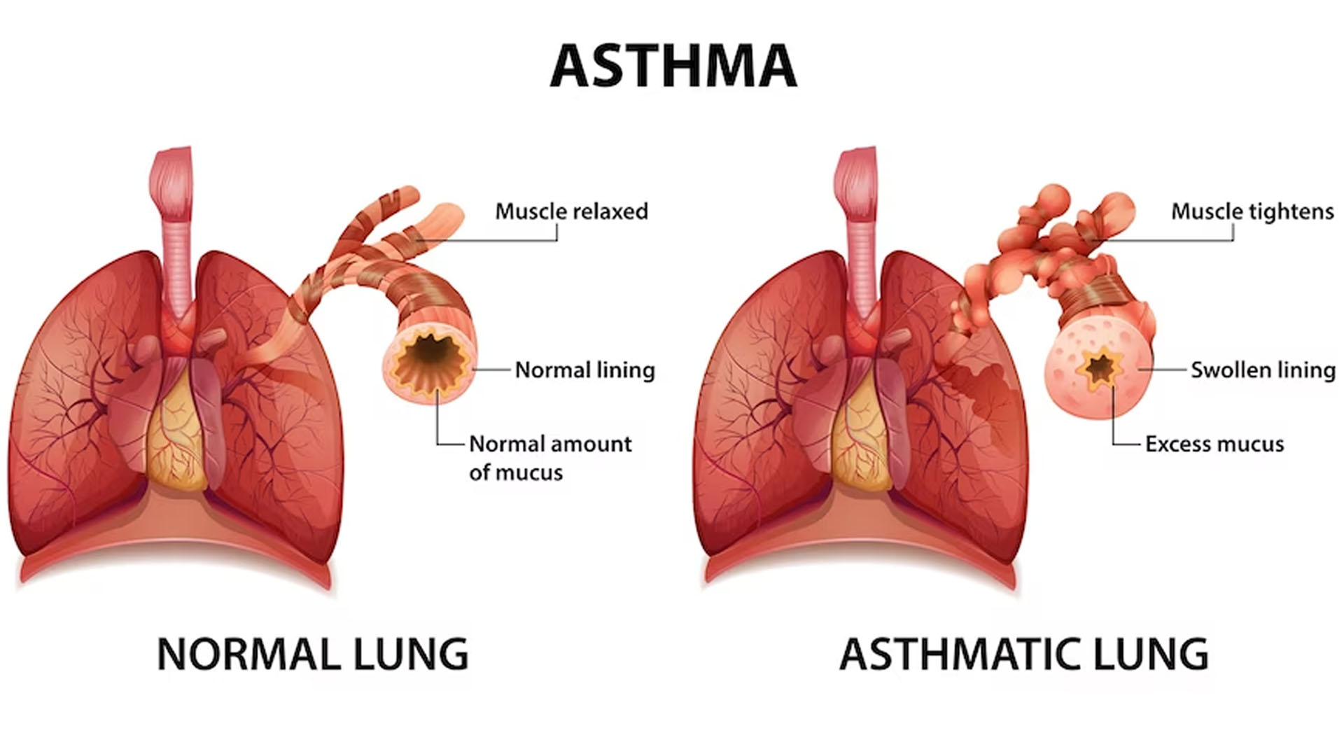 Free vector comparison of healthy lung and asthmatic lung