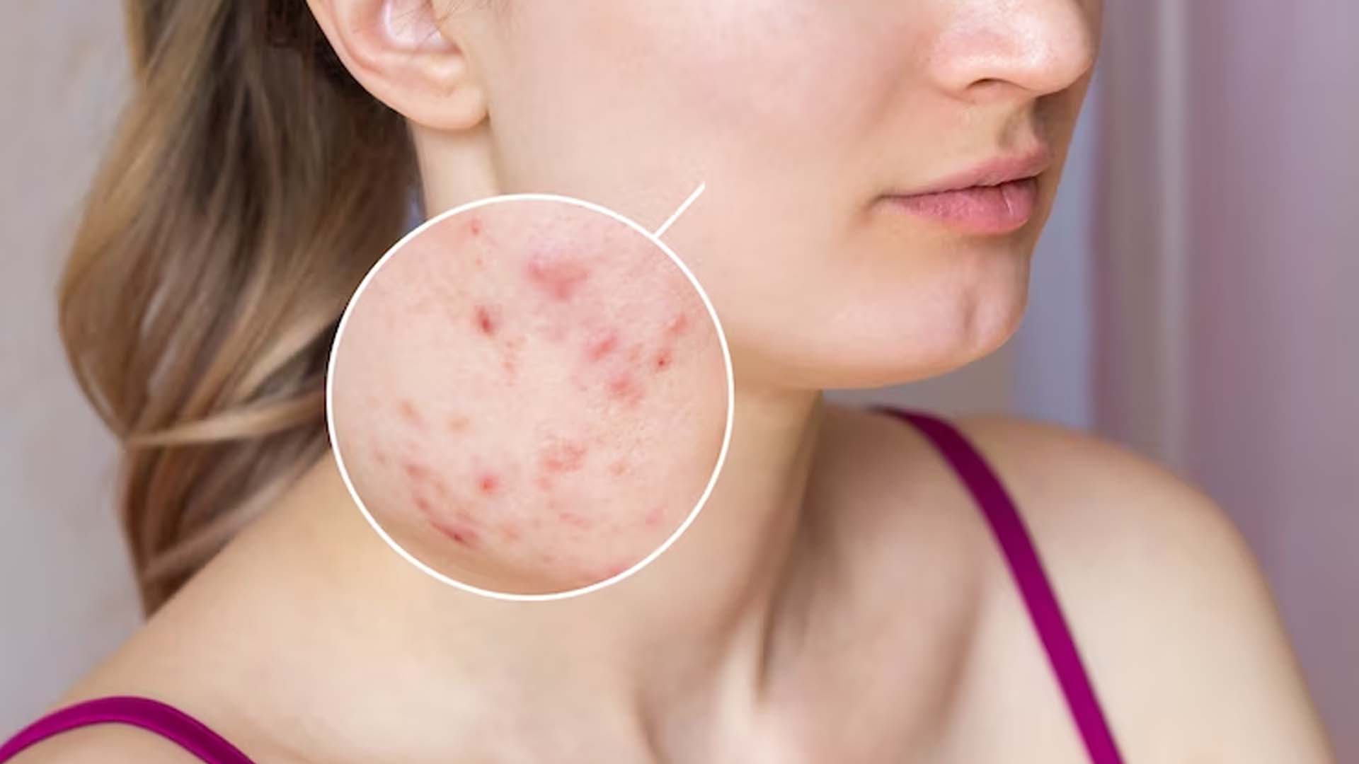 Causes of Acne