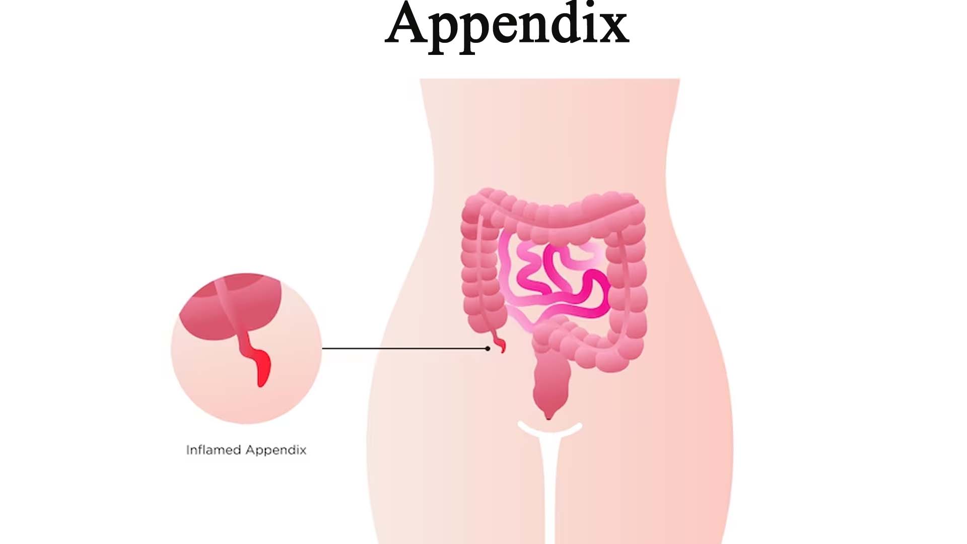 How is Appendix Caused?