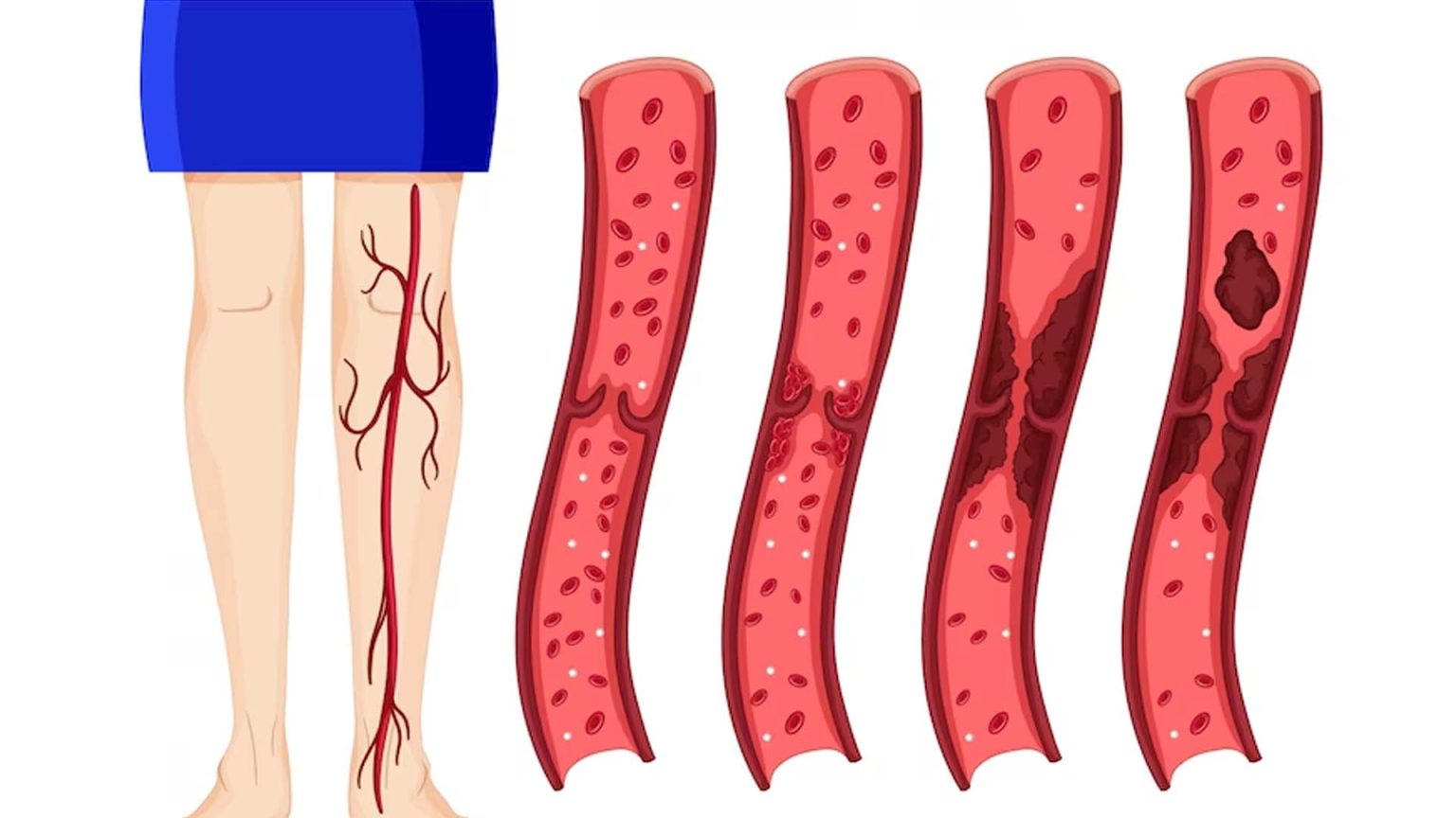 What Causes Blood Clots in Legs? NutritionFact.in