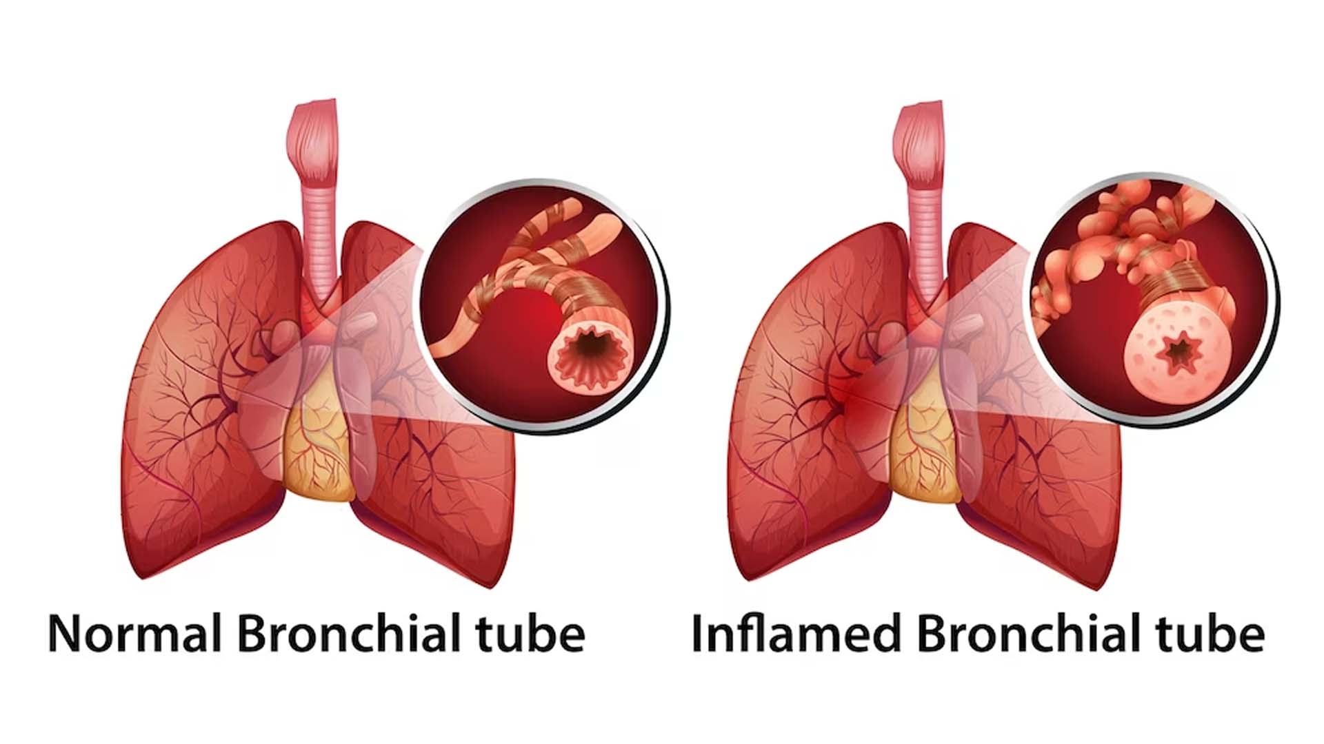 Causes of Bronchitis