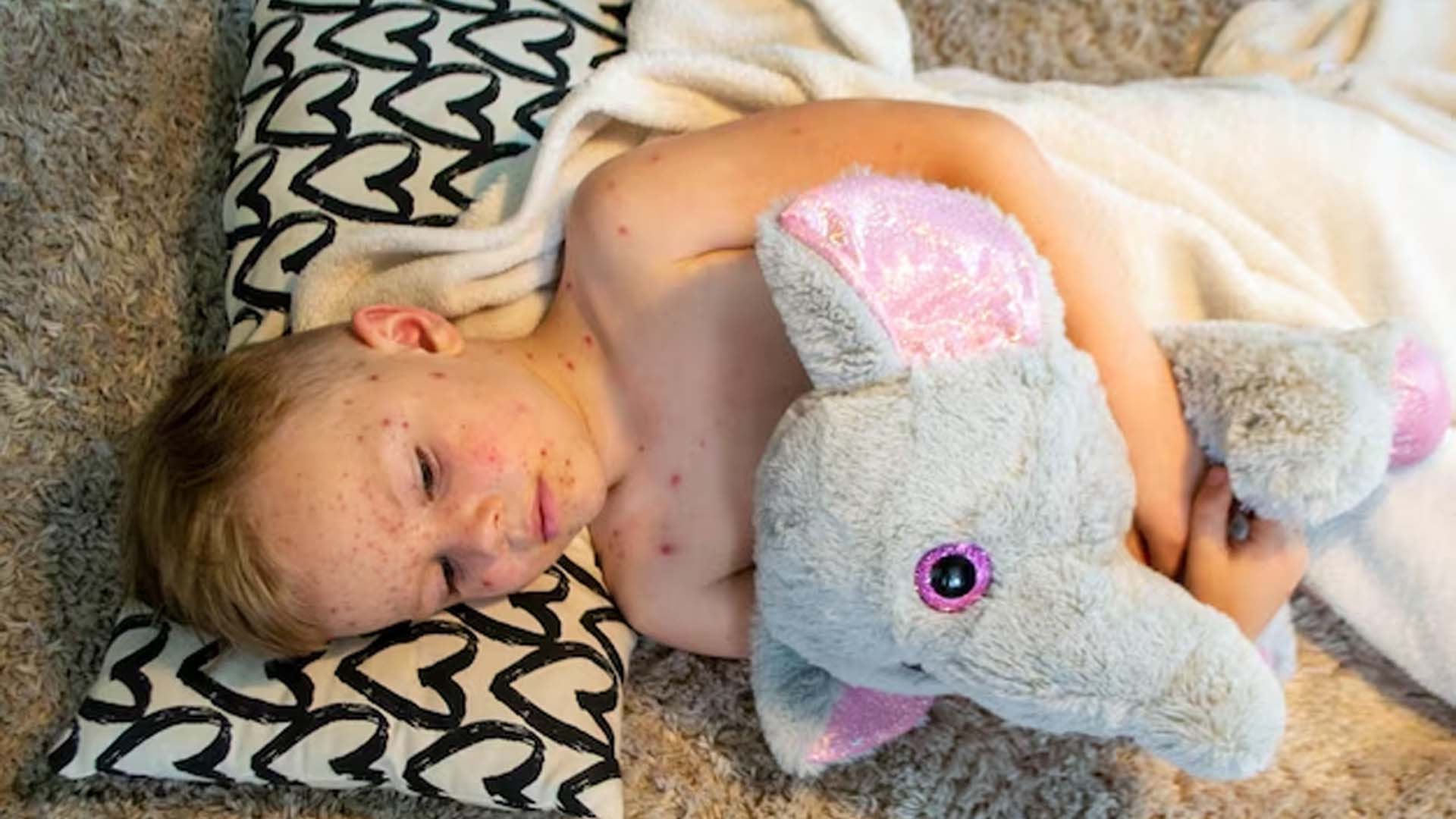 Causes of Chickenpox