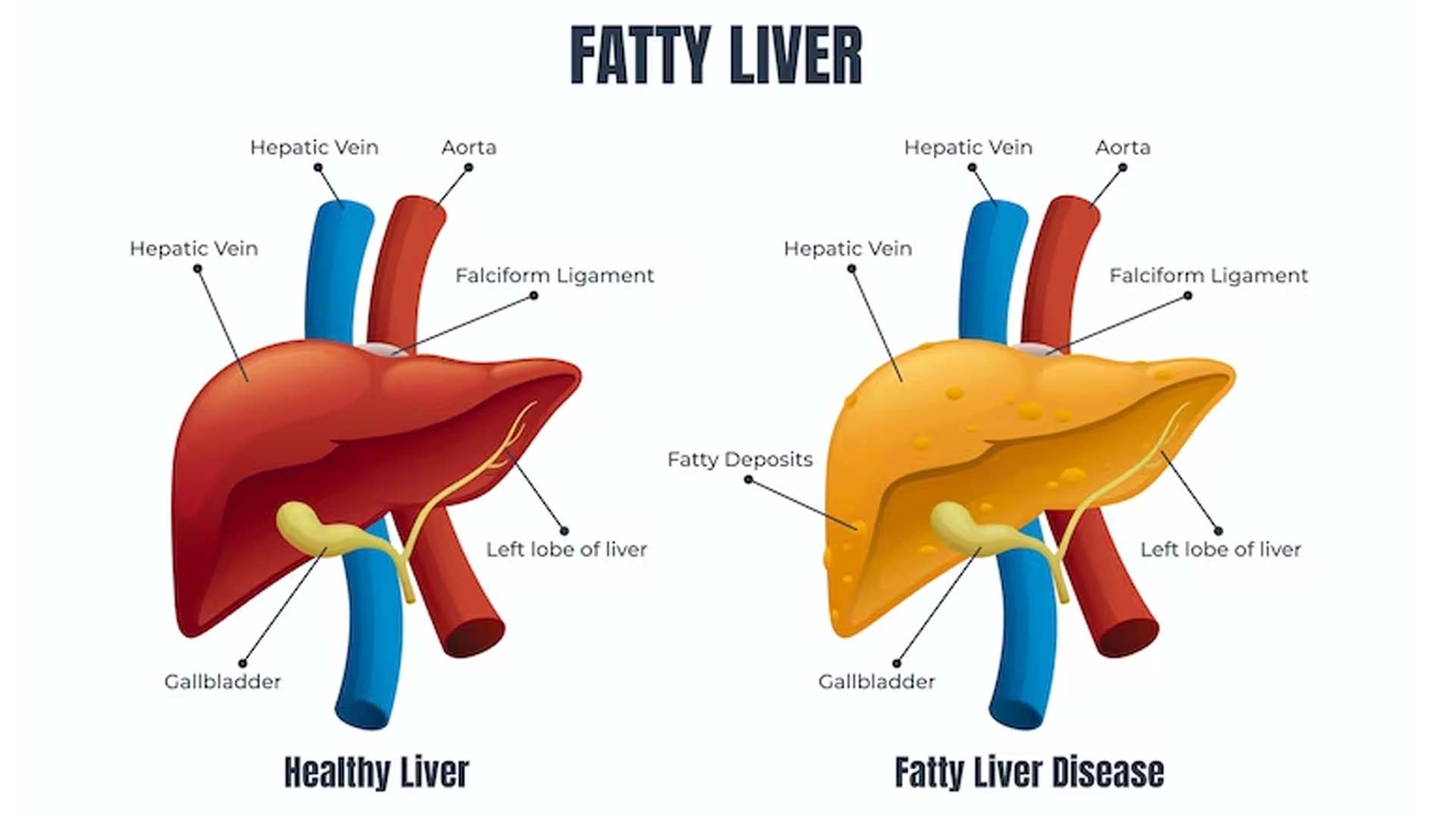 Does Fatty Liver Cause Pain?