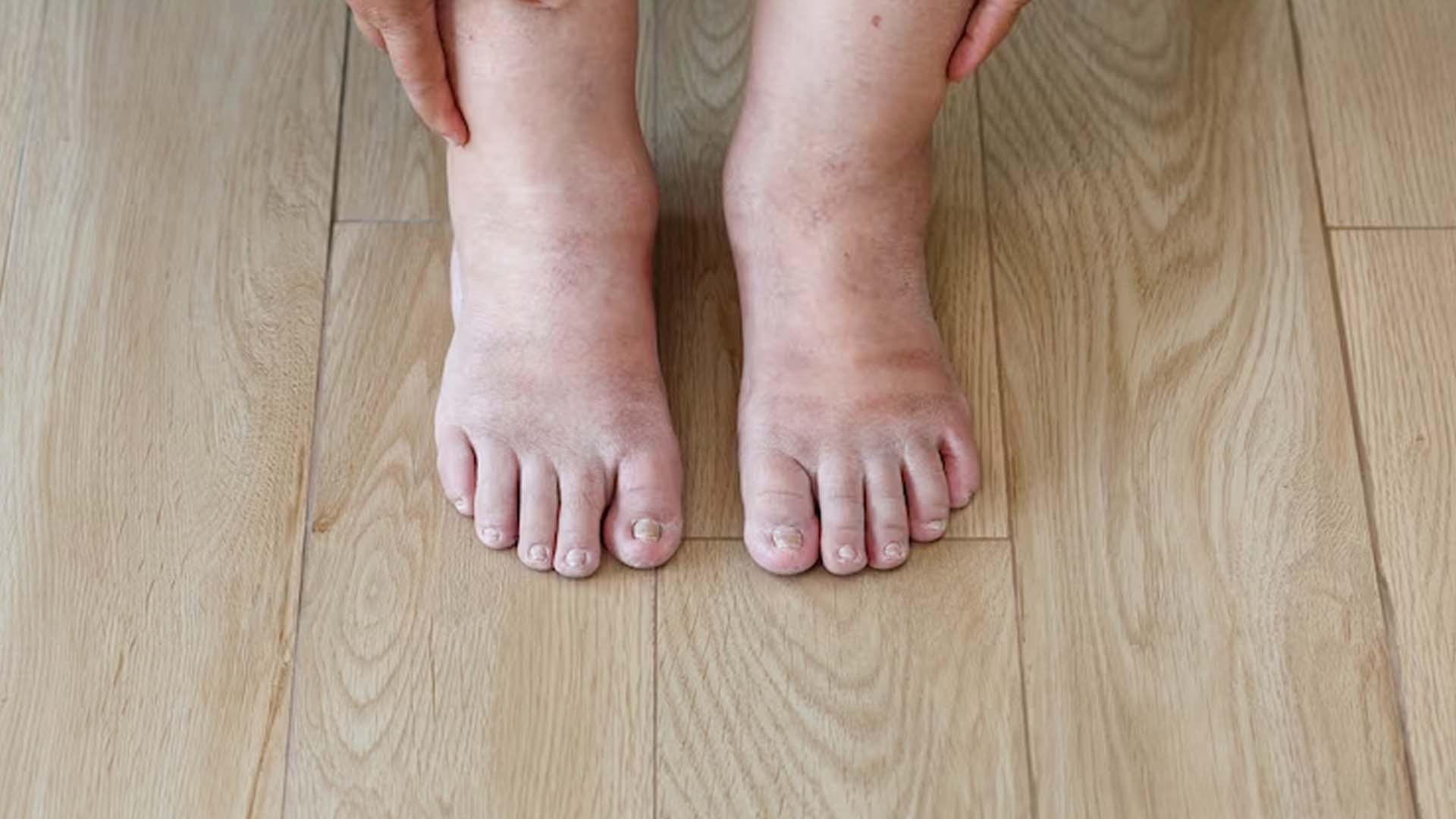 Causes of Feet to Swell