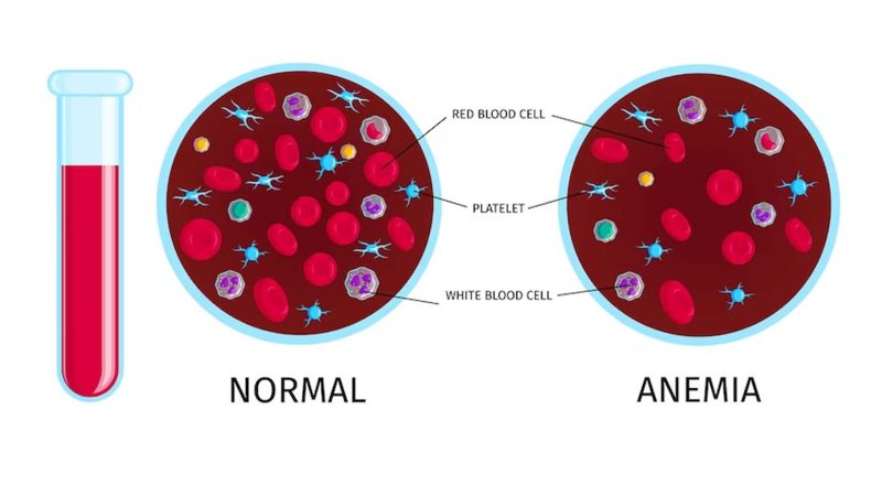 What Causes Iron Deficiency NutritionFact in