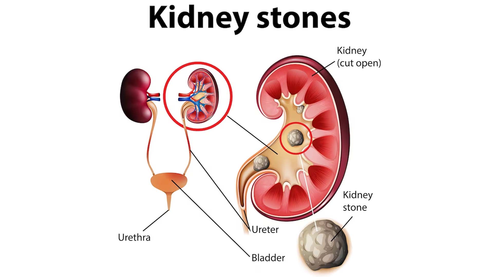 Do Kidney Stones Cause Back Pain?