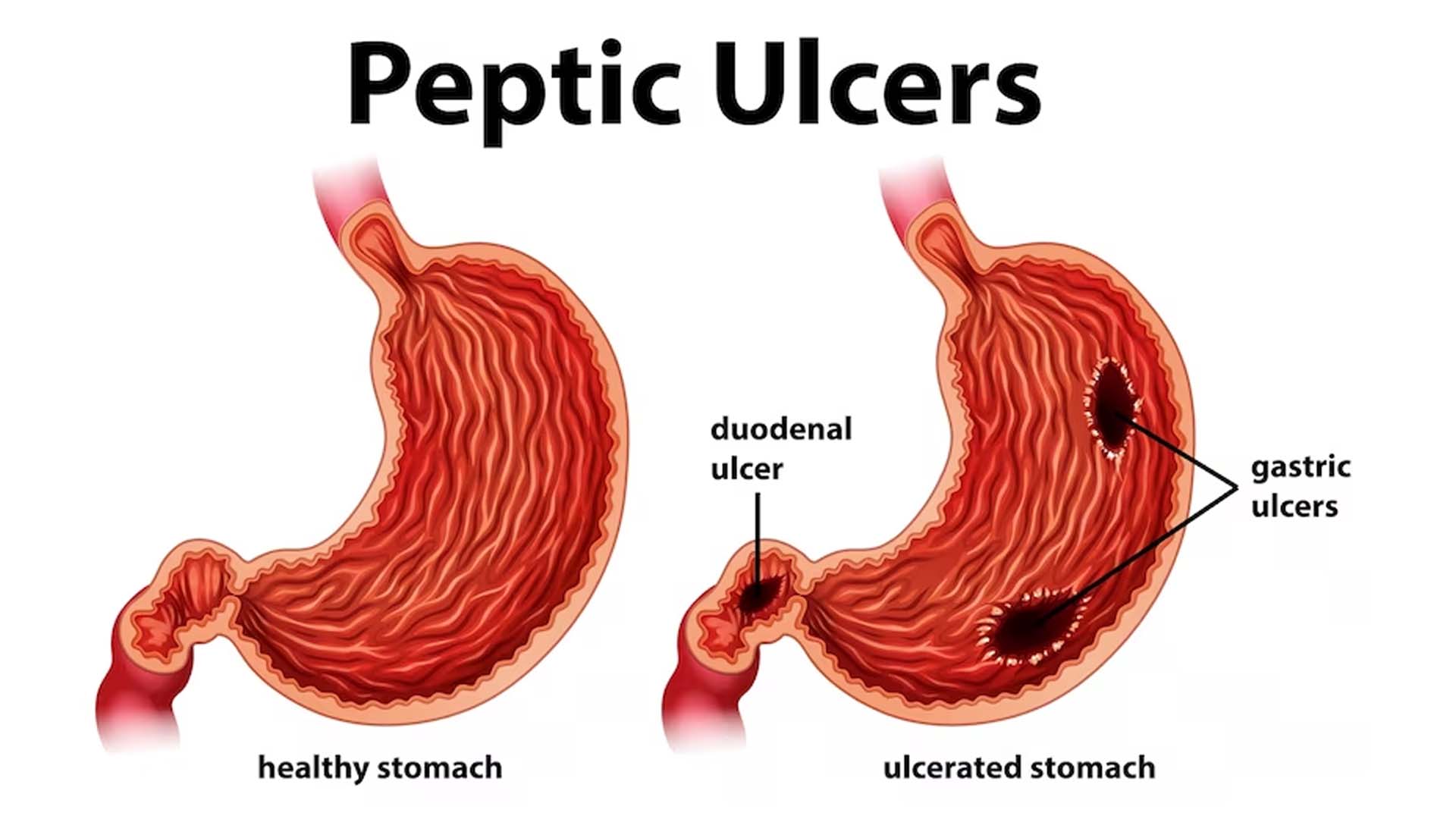 Causes Peptic Ulcers