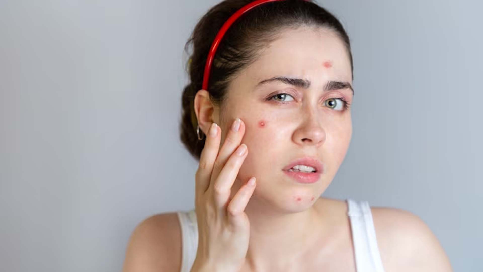 causes of pimples