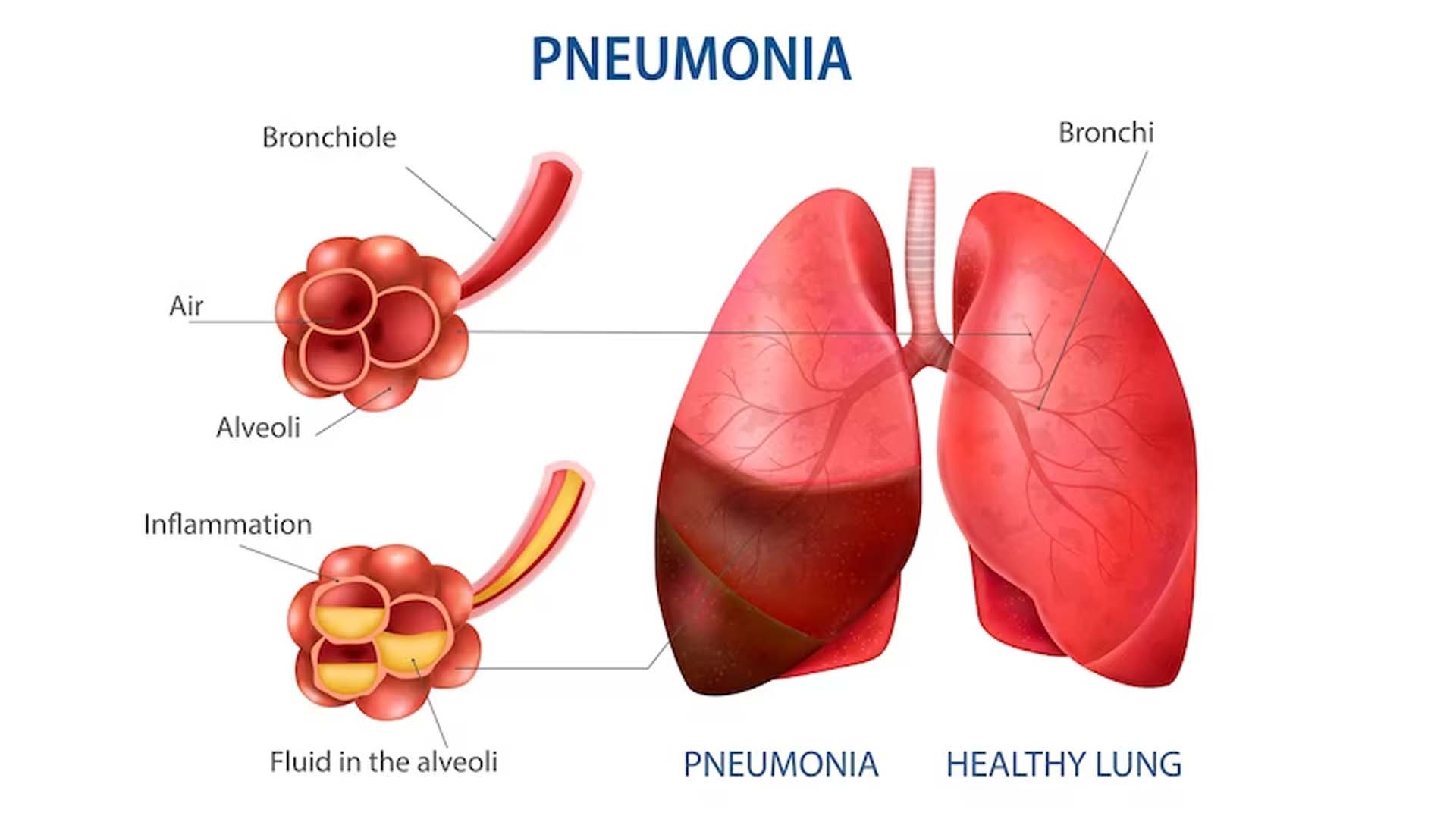 Causes of Pneumonia
