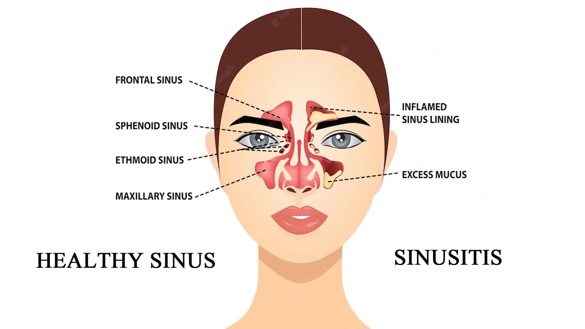 Causes of Sinusitis