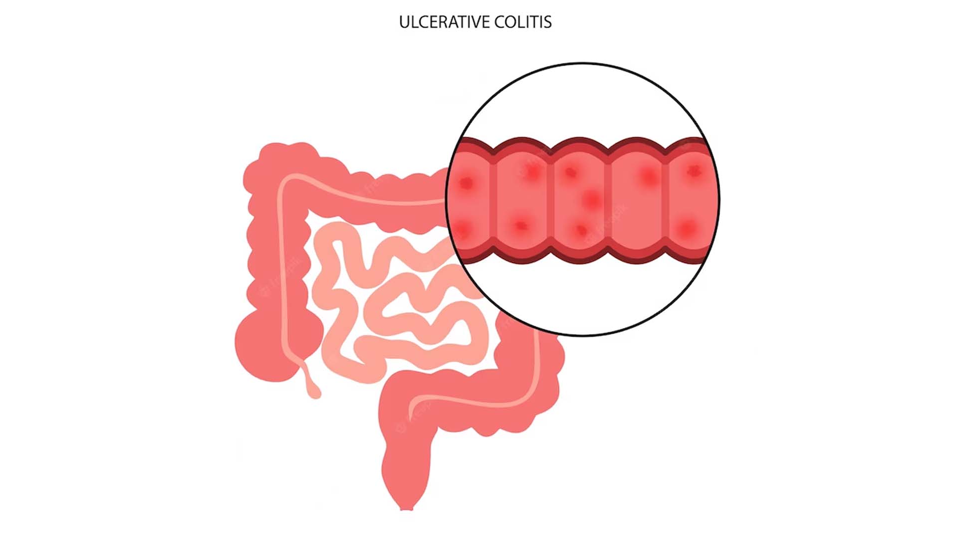Causes of Colitis