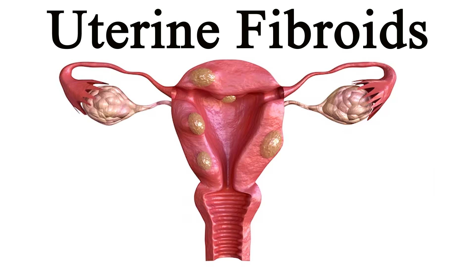 Causes of Uterine Fibroids