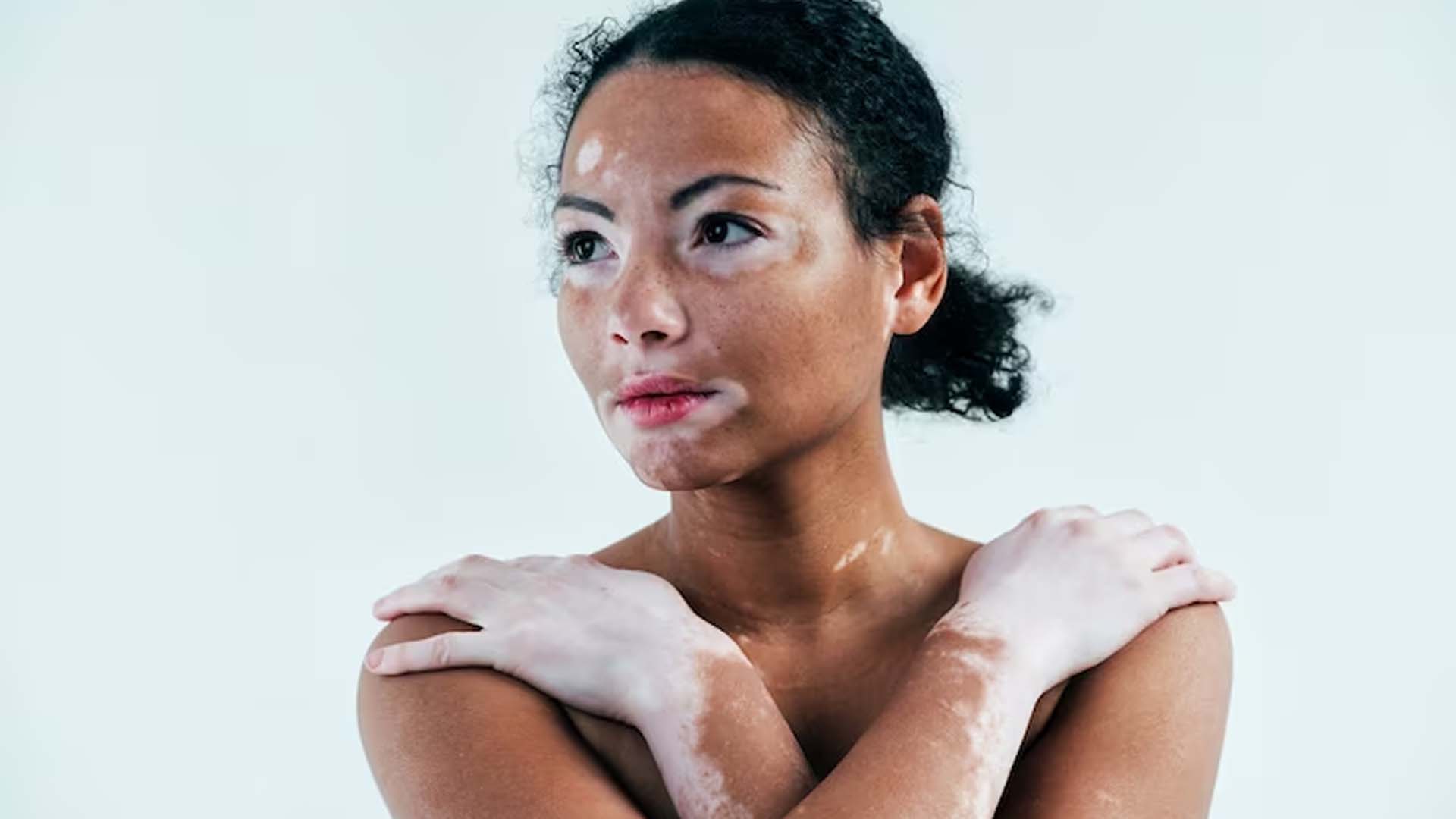 Vitiligo Skin