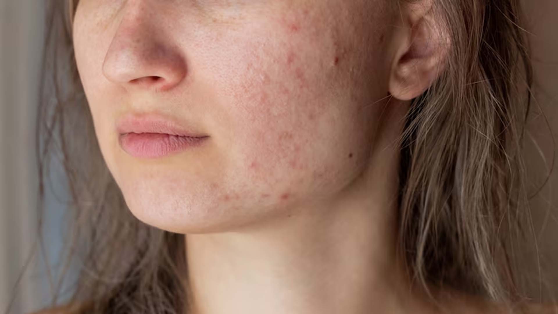 Women with Acne