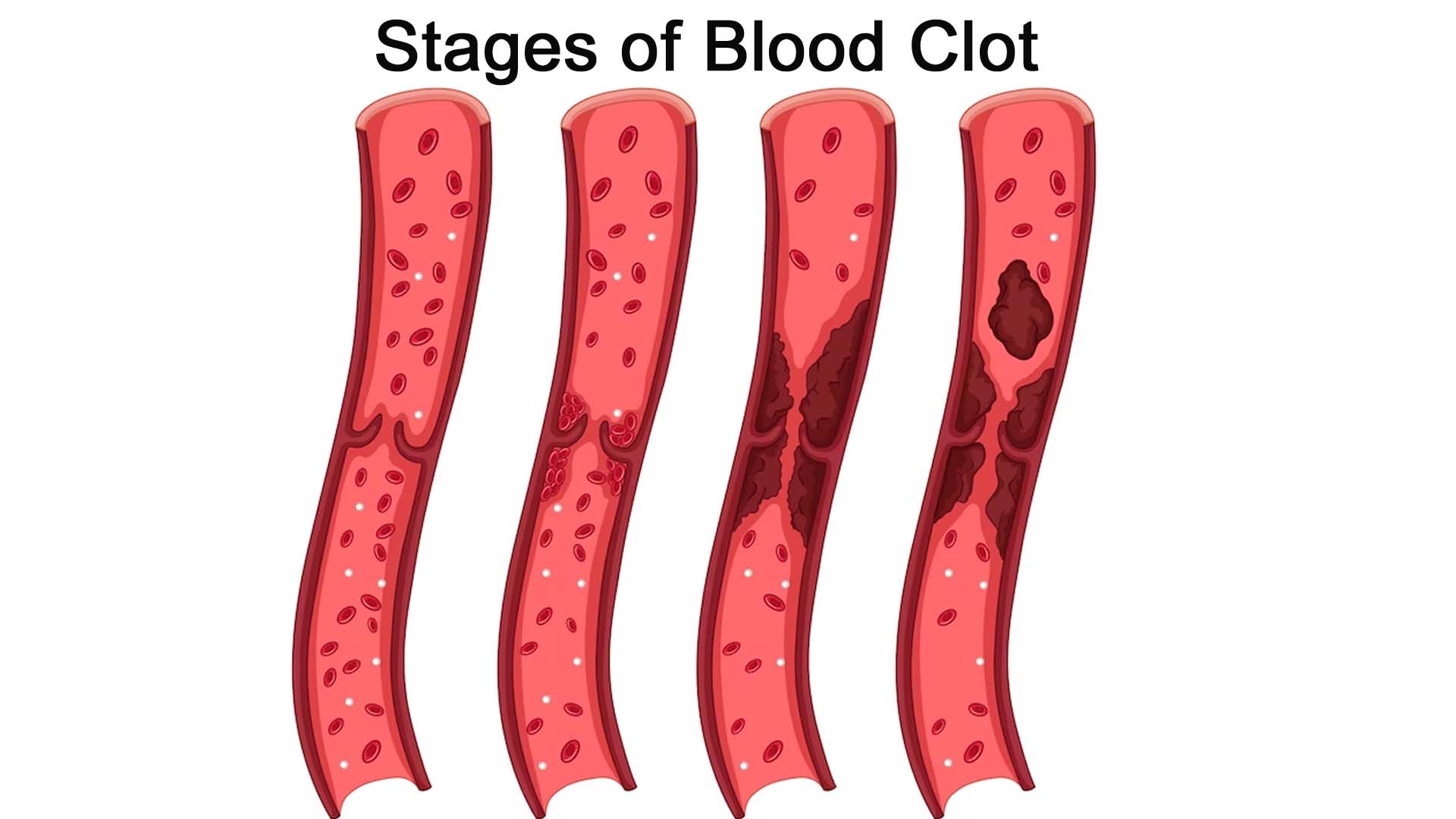 Blood Clots in Leg
