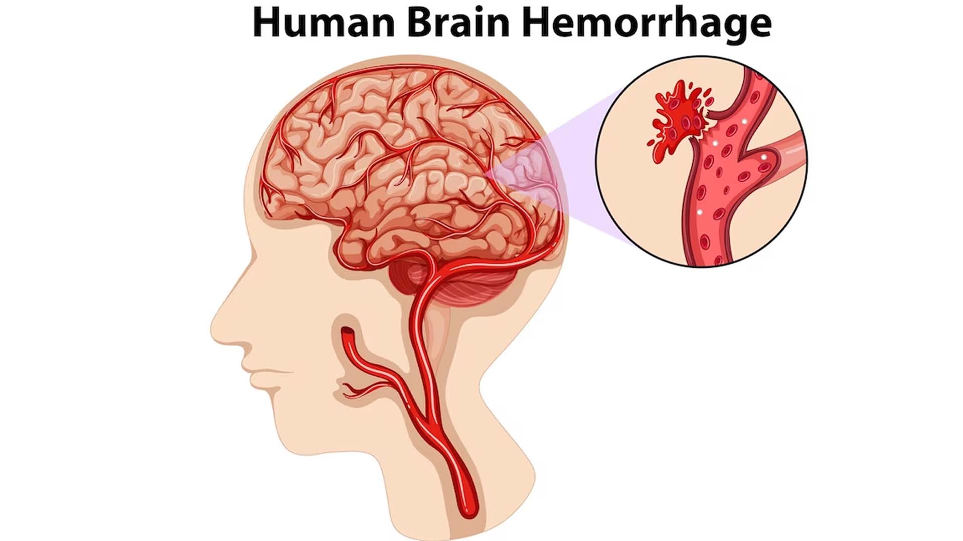 Cerebral hemorrhage or Intracranial hemorrhage