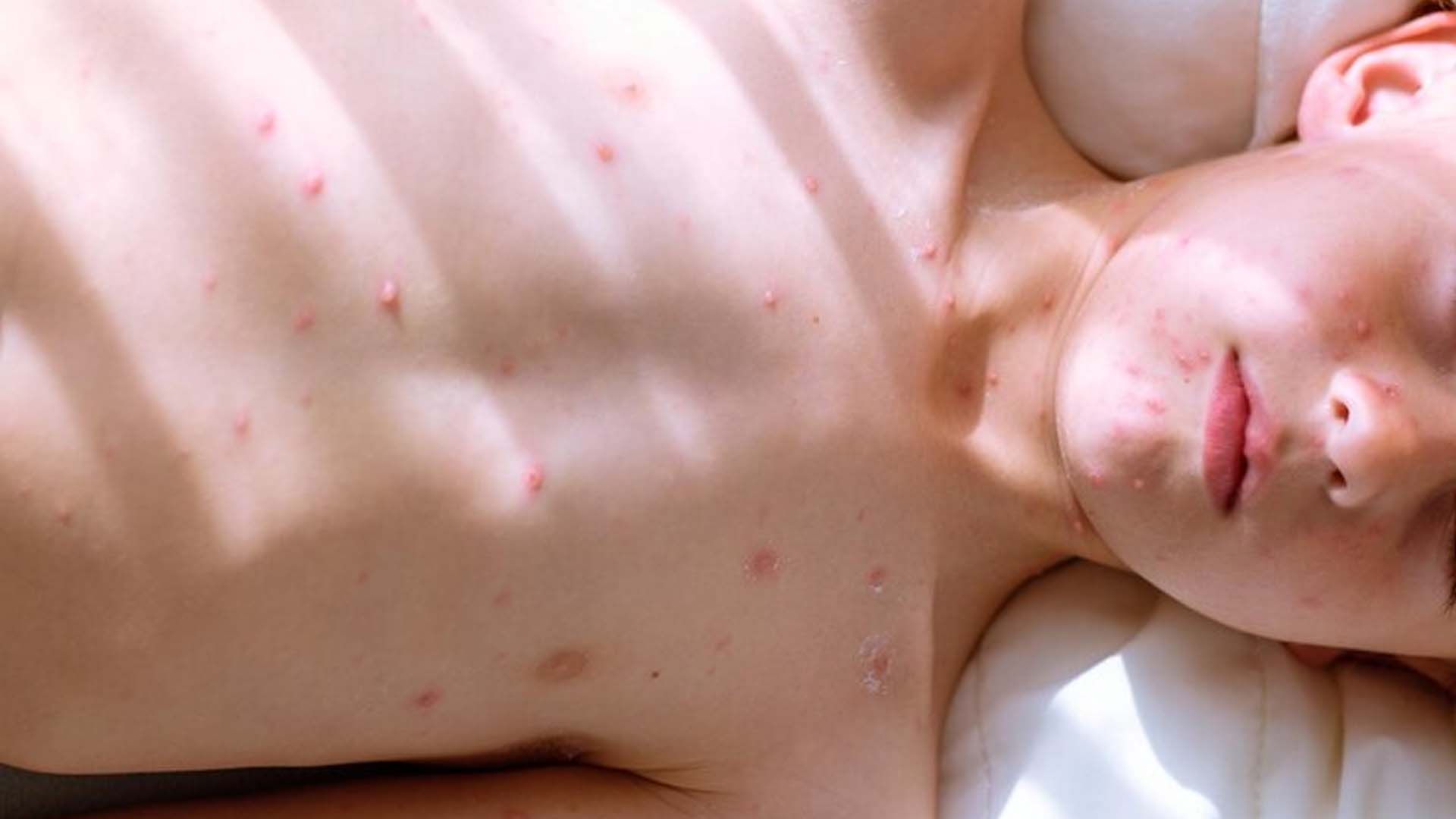 Chickenpox