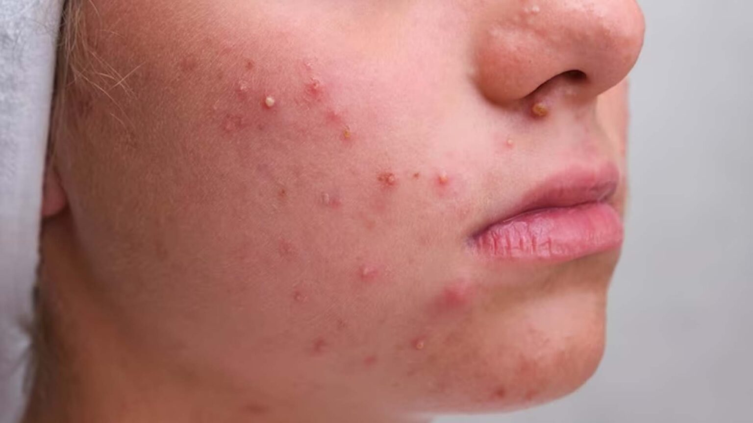 What Causes Cystic Acne? NutritionFact.in