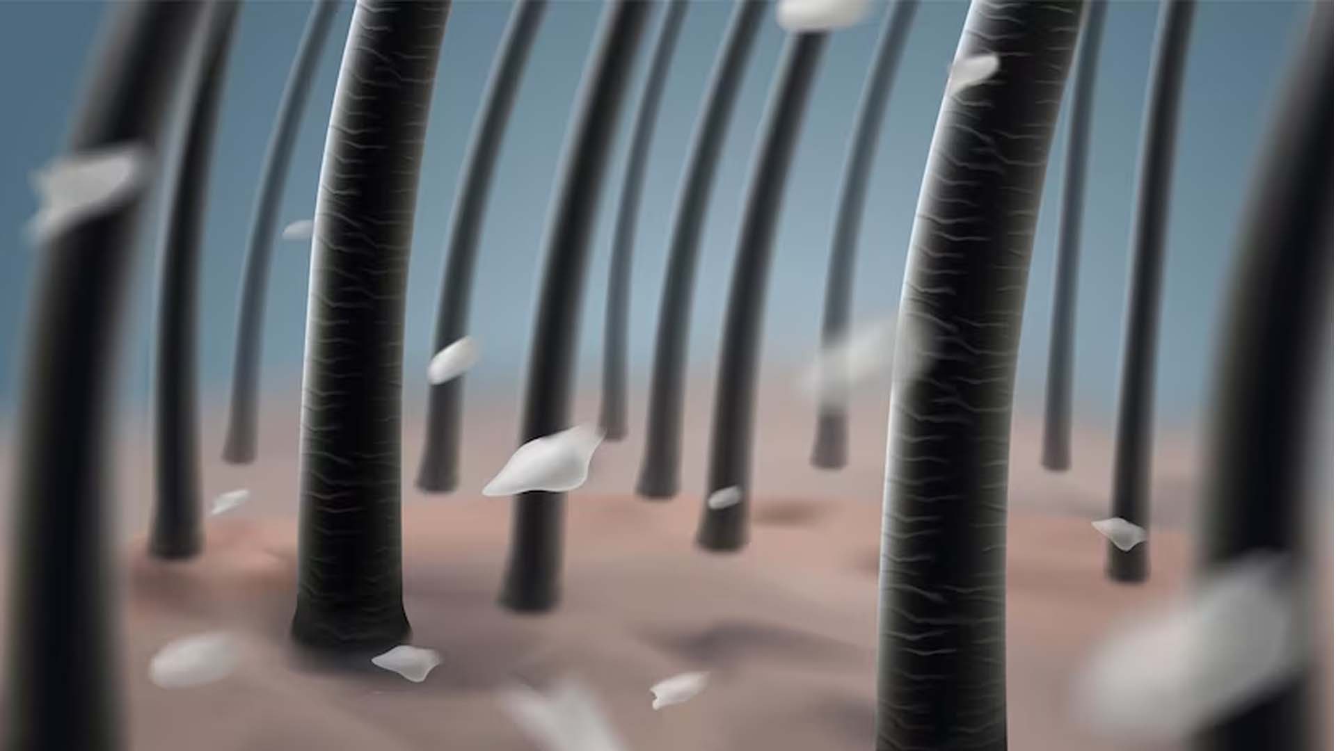 Dandruff
