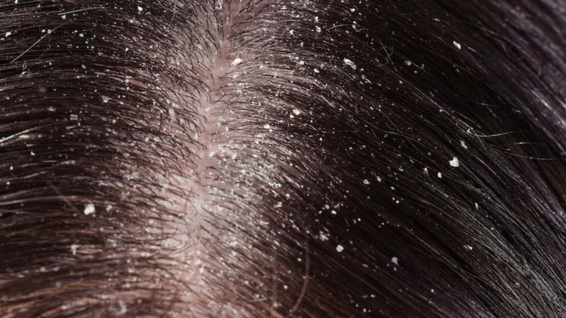 Most Common Causes of Grey Hair & How Can You Reverse It - Bodytales