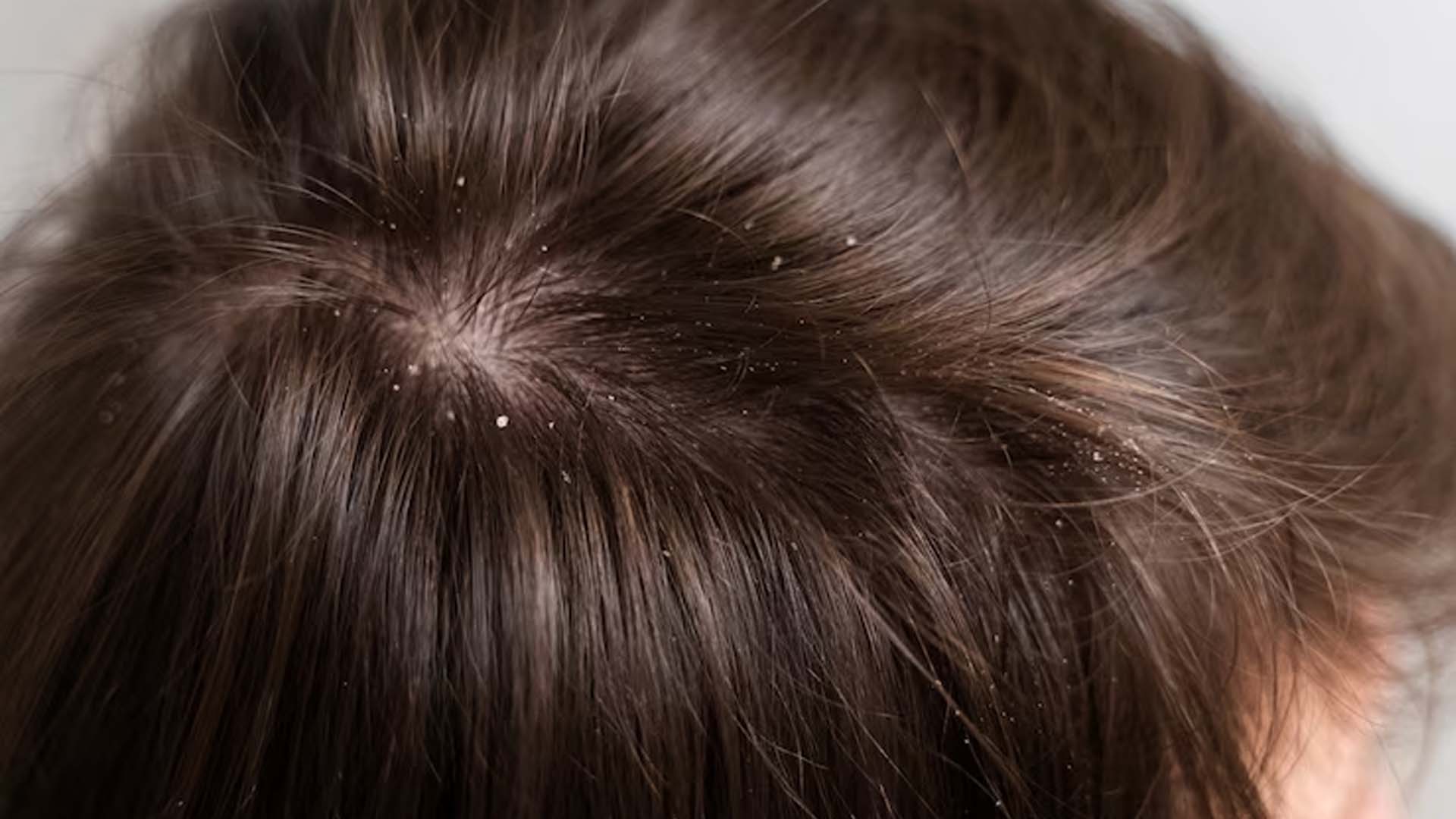 Can Dandruff Cause Pimples?