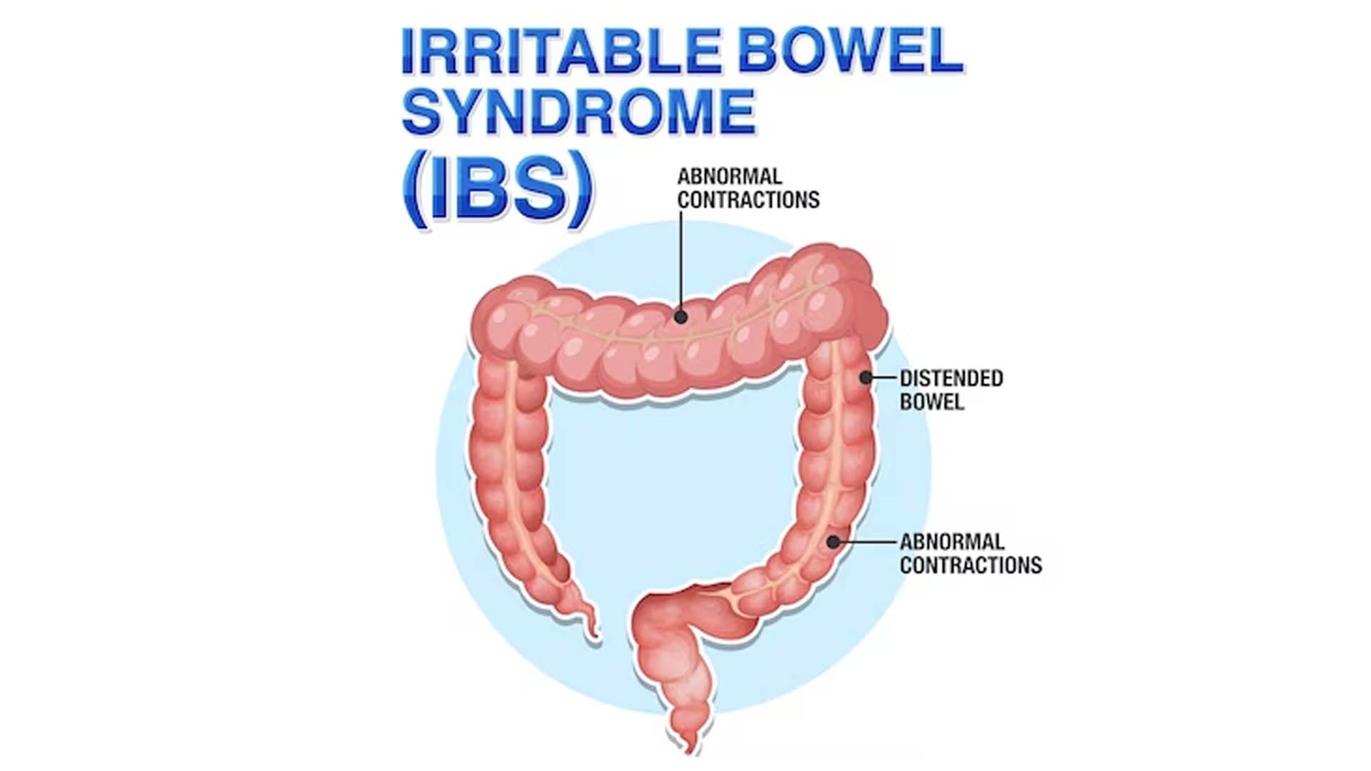 Irritable Bowel Syndrome (IBS)