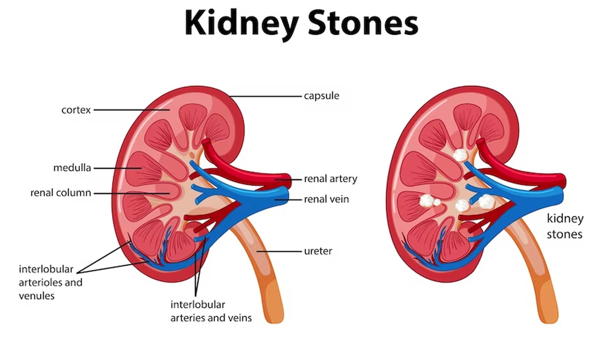 Kidney Stones anatomy