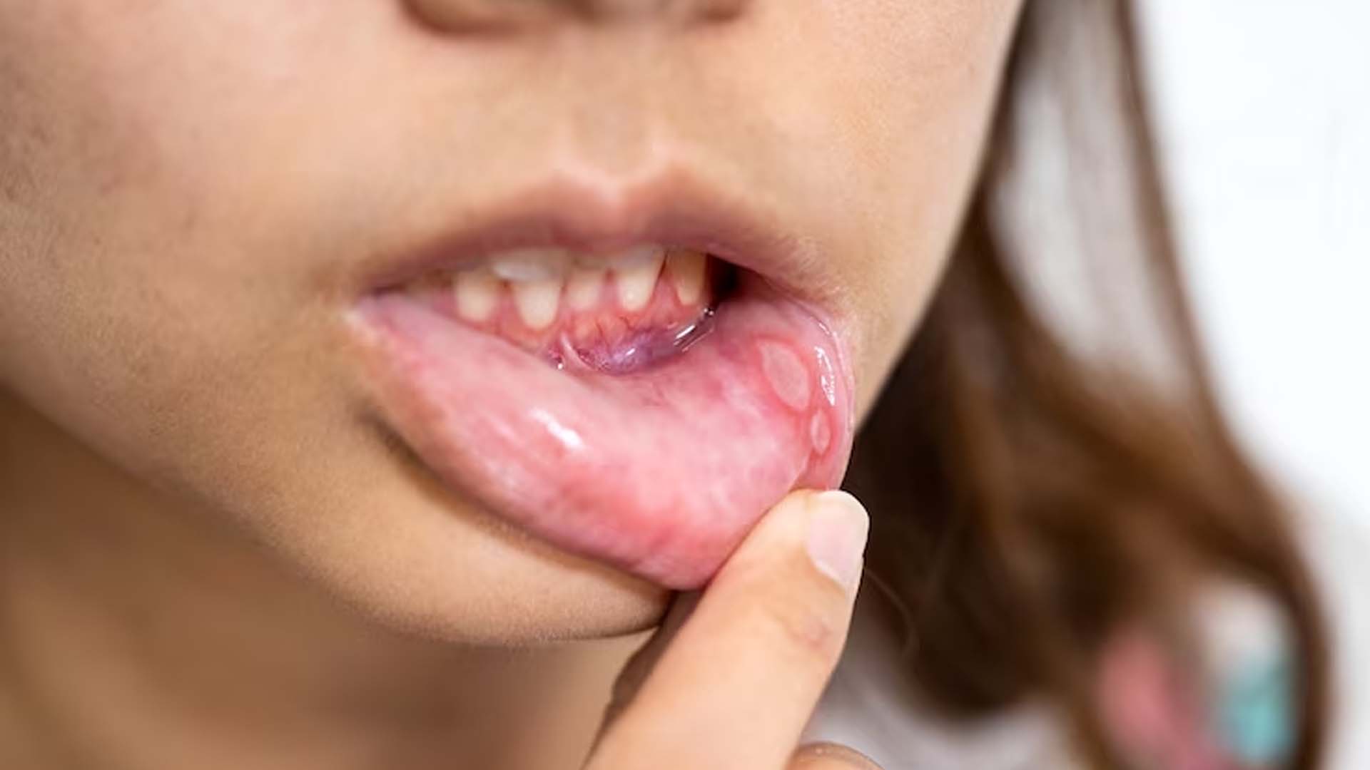 Can Stress Cause Mouth Ulcers?