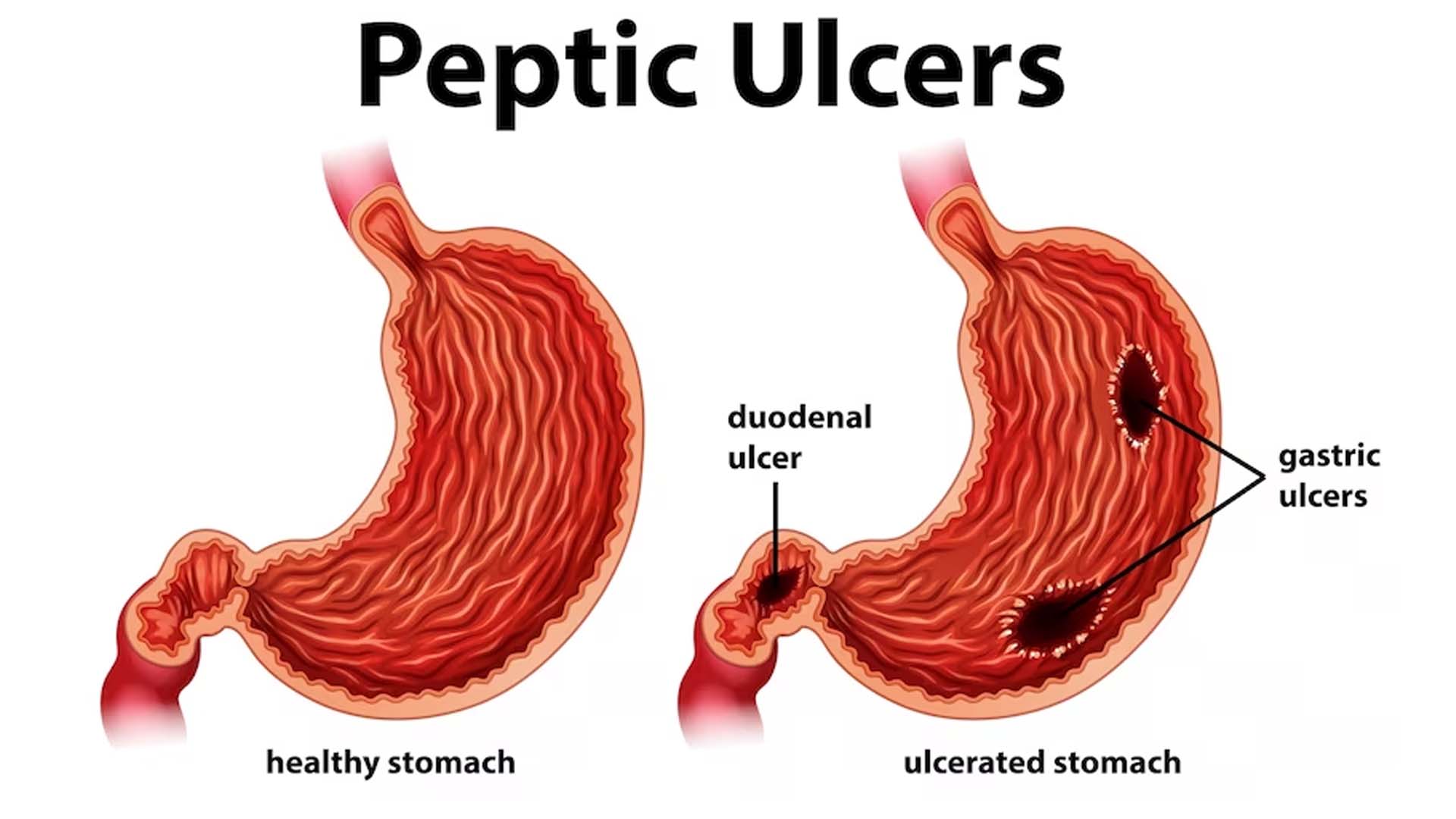 Peptic Ulcer