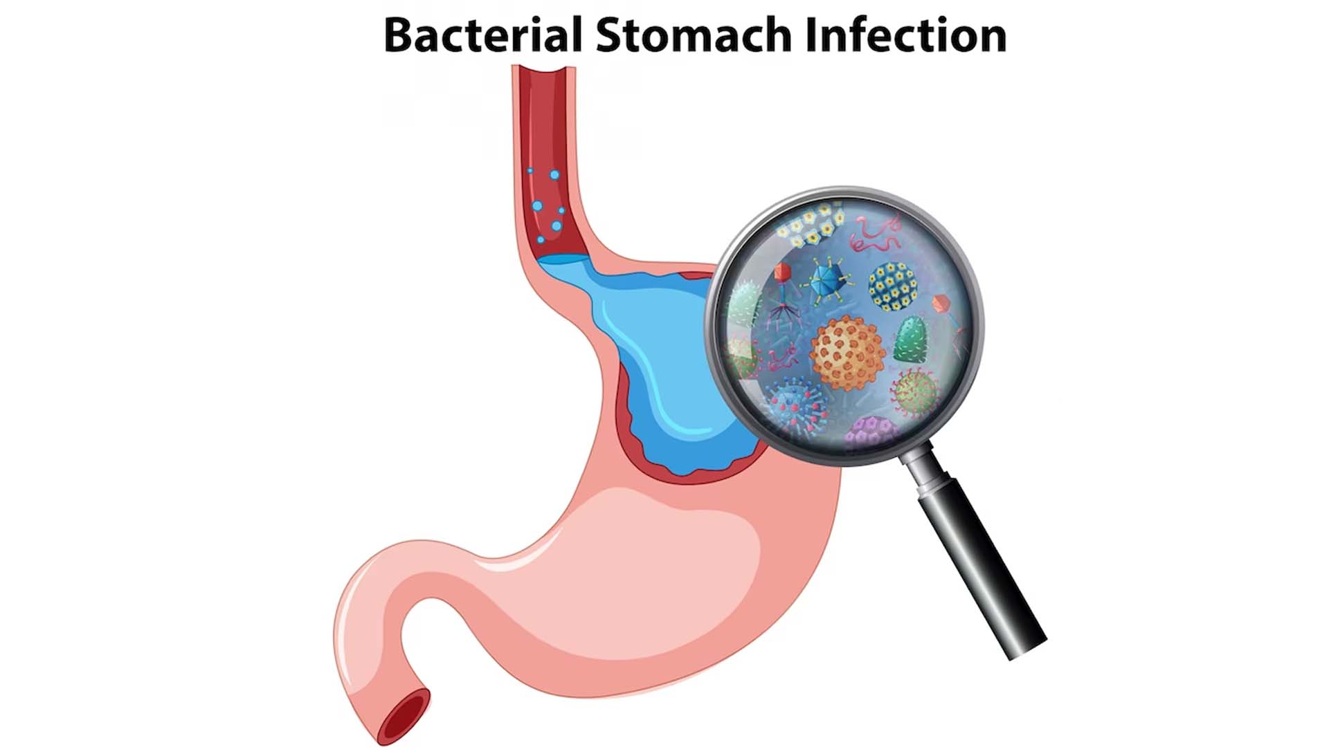Stomach Infection