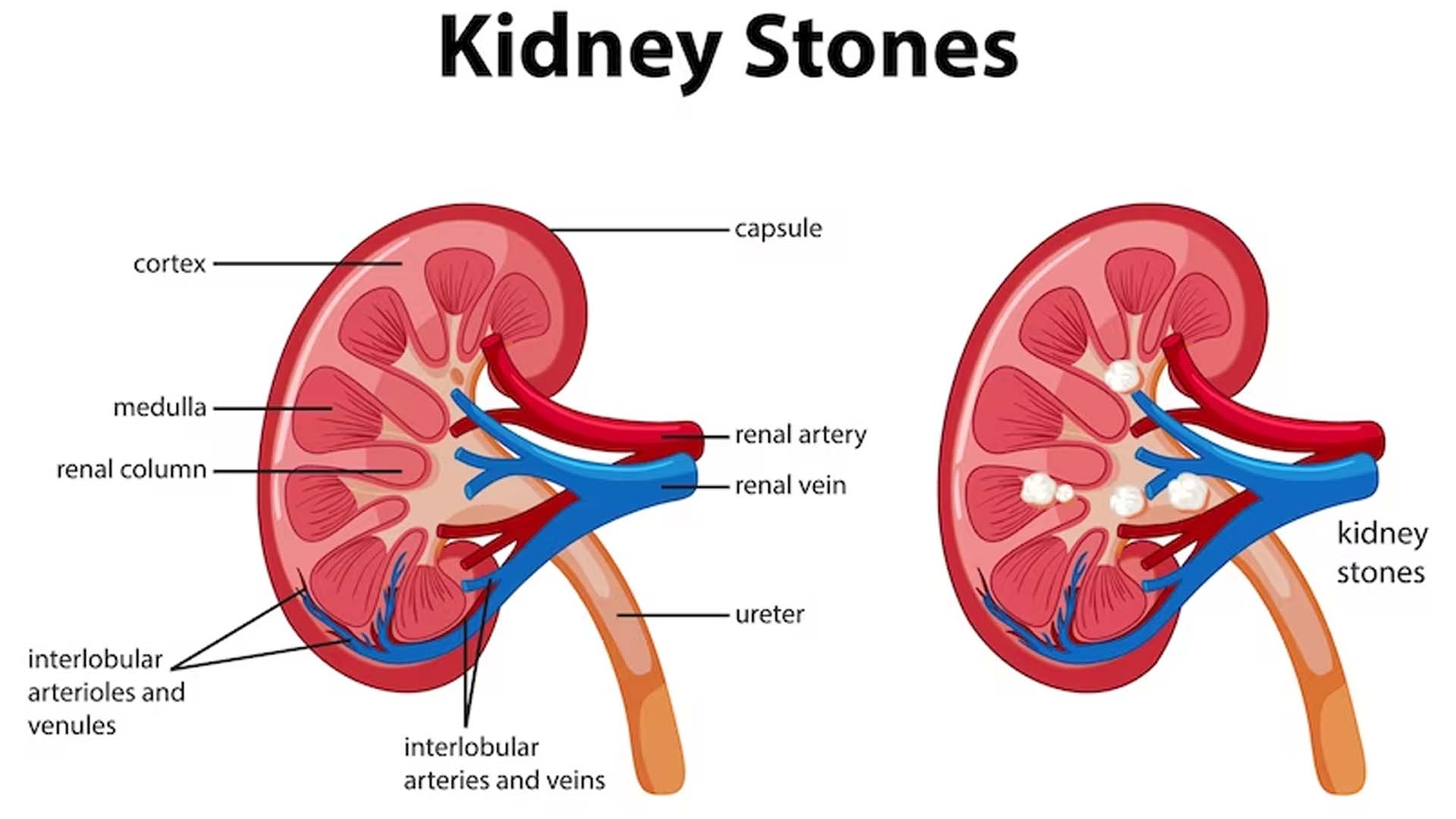 Kidney Stones Anatomy