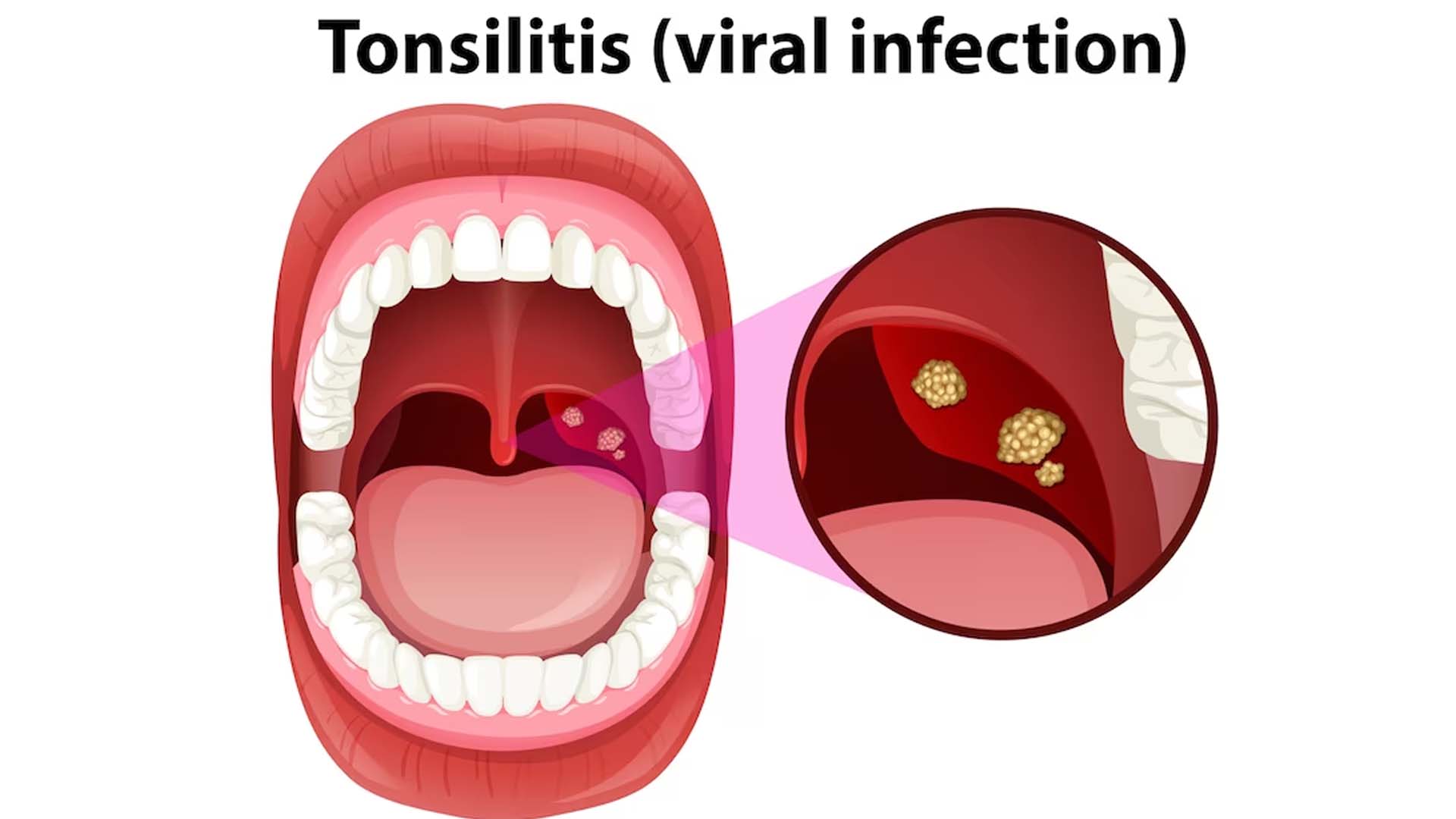 Does Tonsillitis Cause Fever?