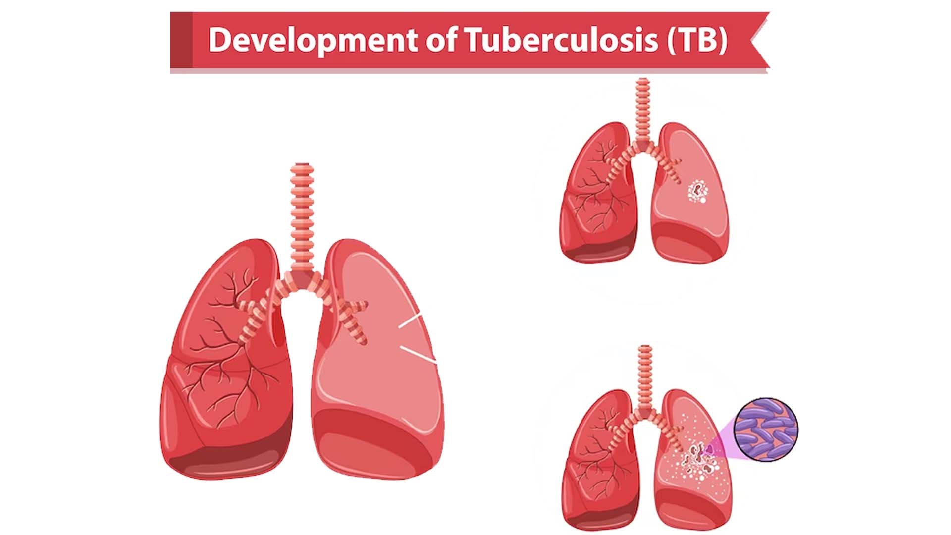 Why TB Causes?
