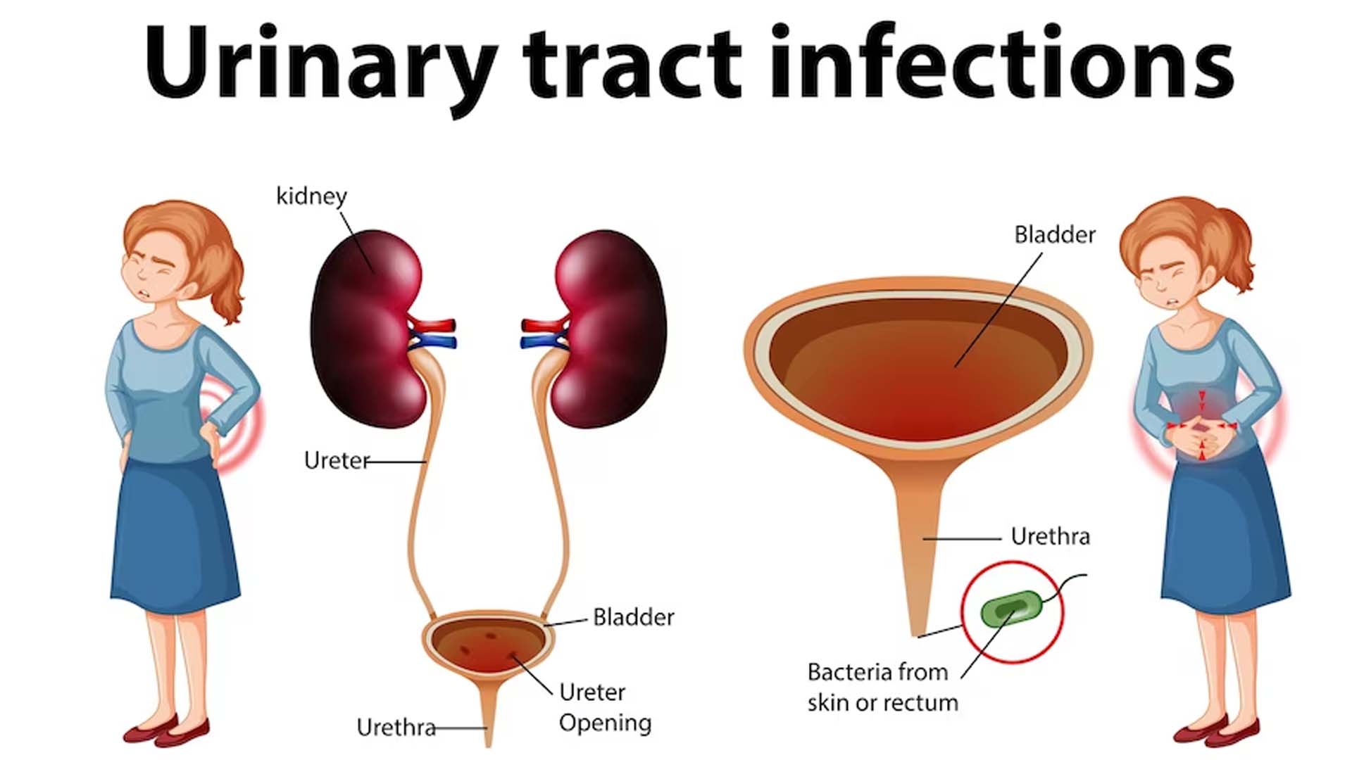 urinary tract infection (UTI)