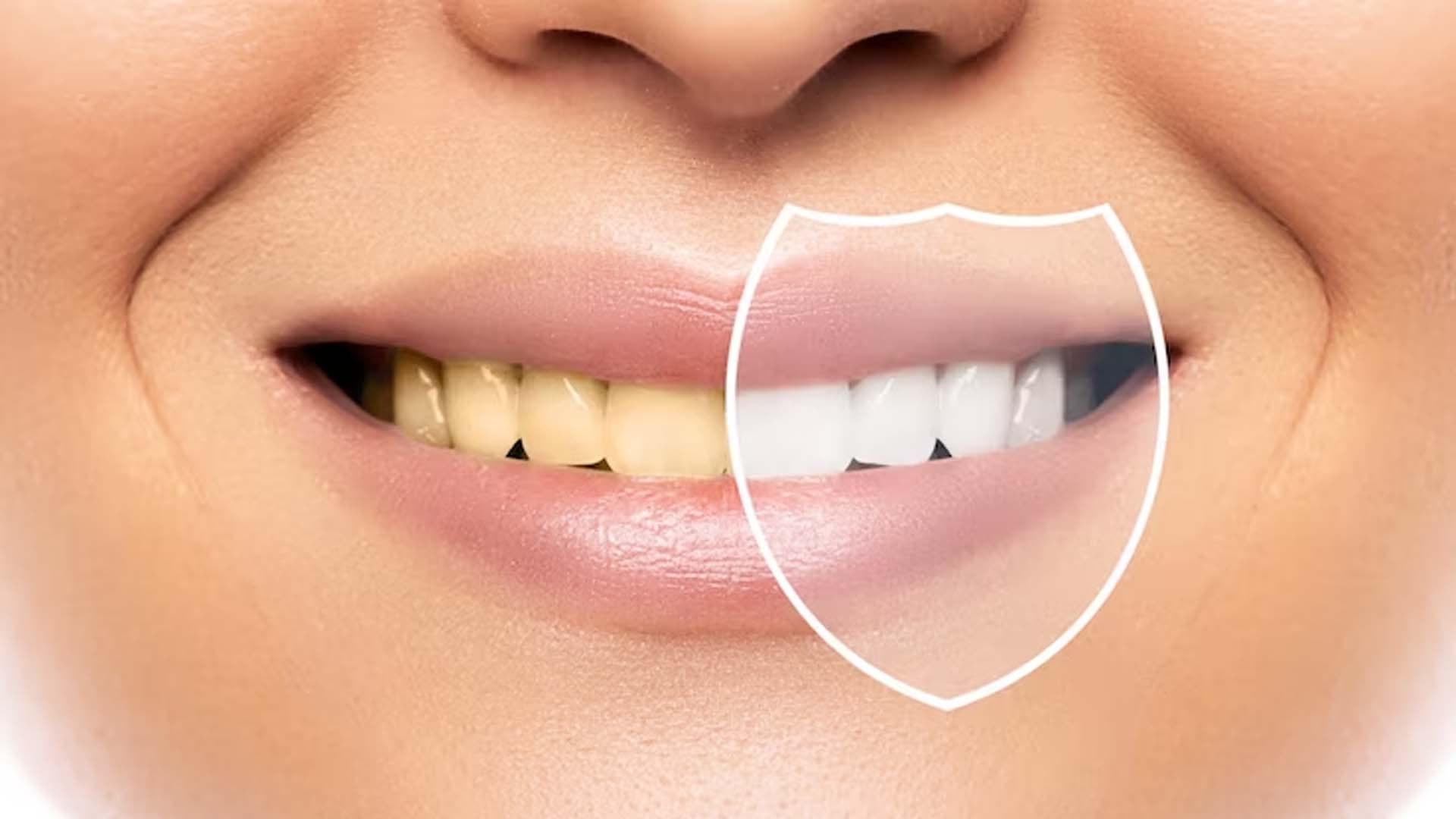 Yellow Teeth vs white teeth
