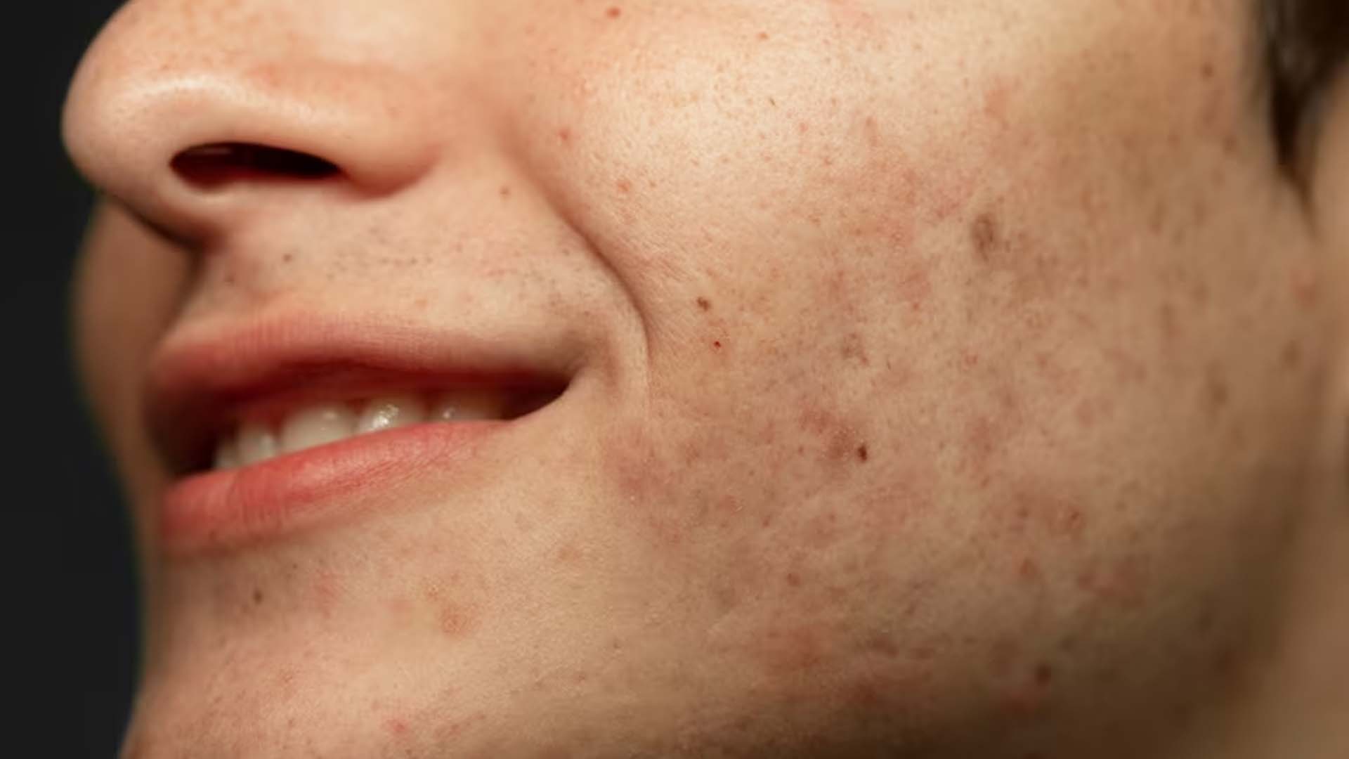 Acne Scars