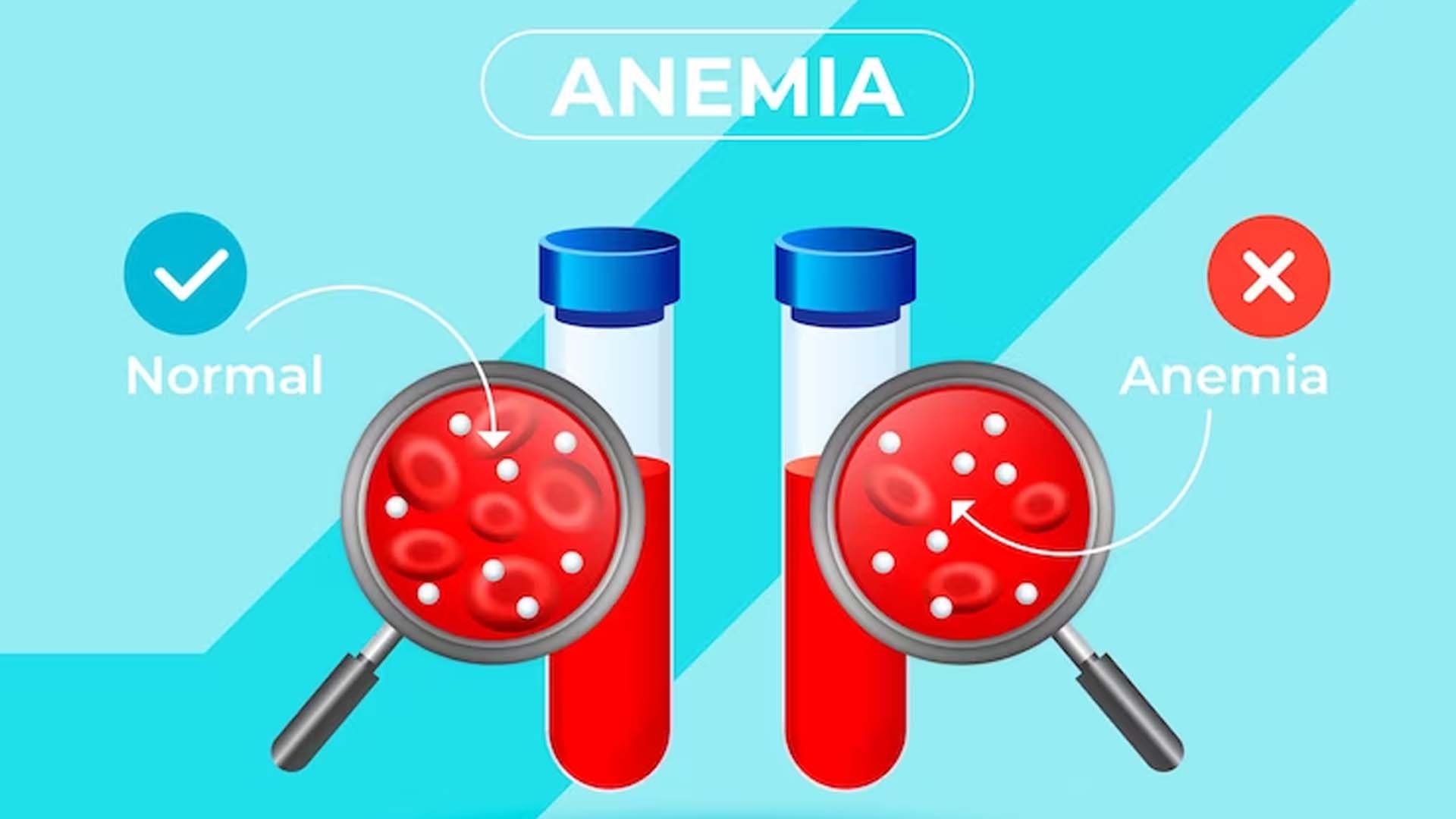 Anemia