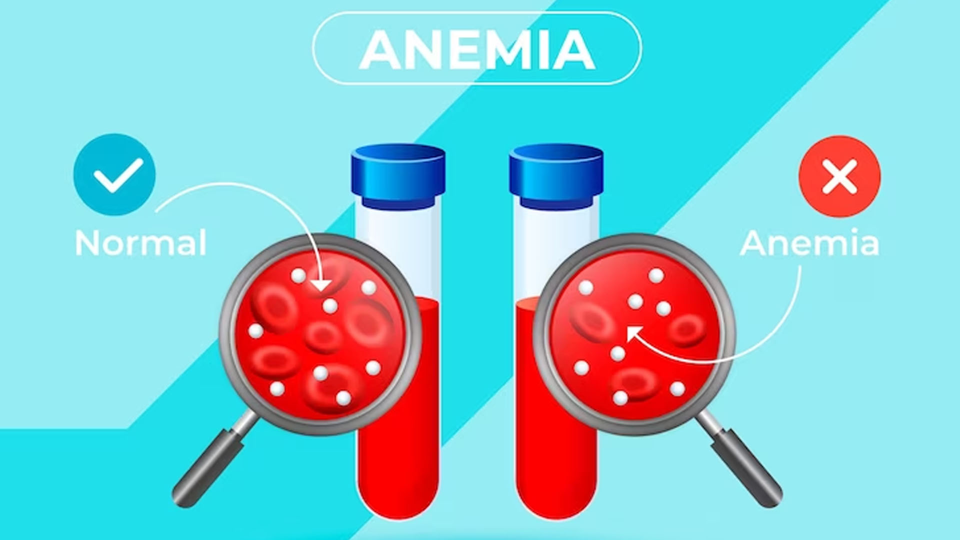 What are the Symptoms of Anemia?