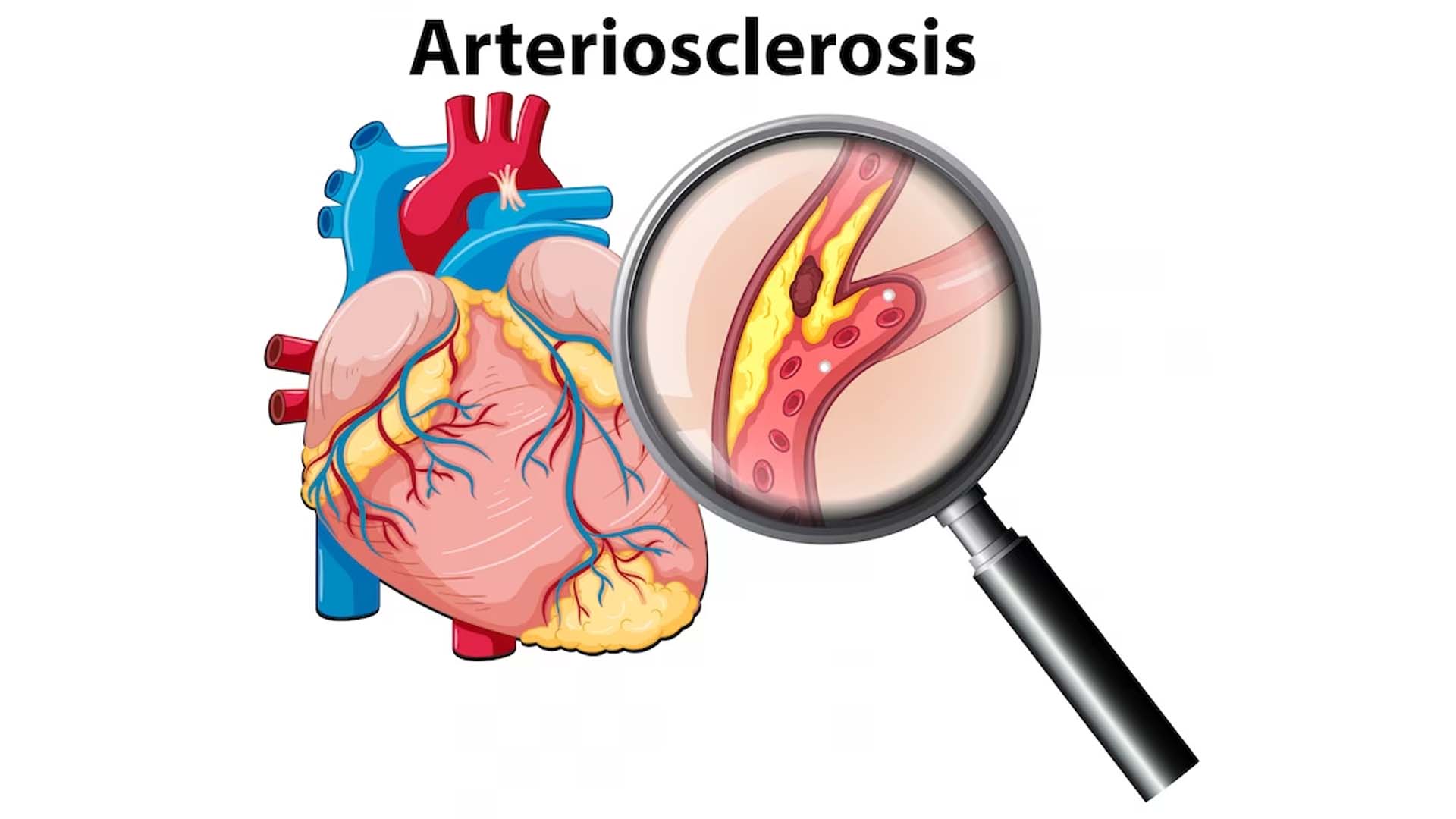 Atherosclerosis