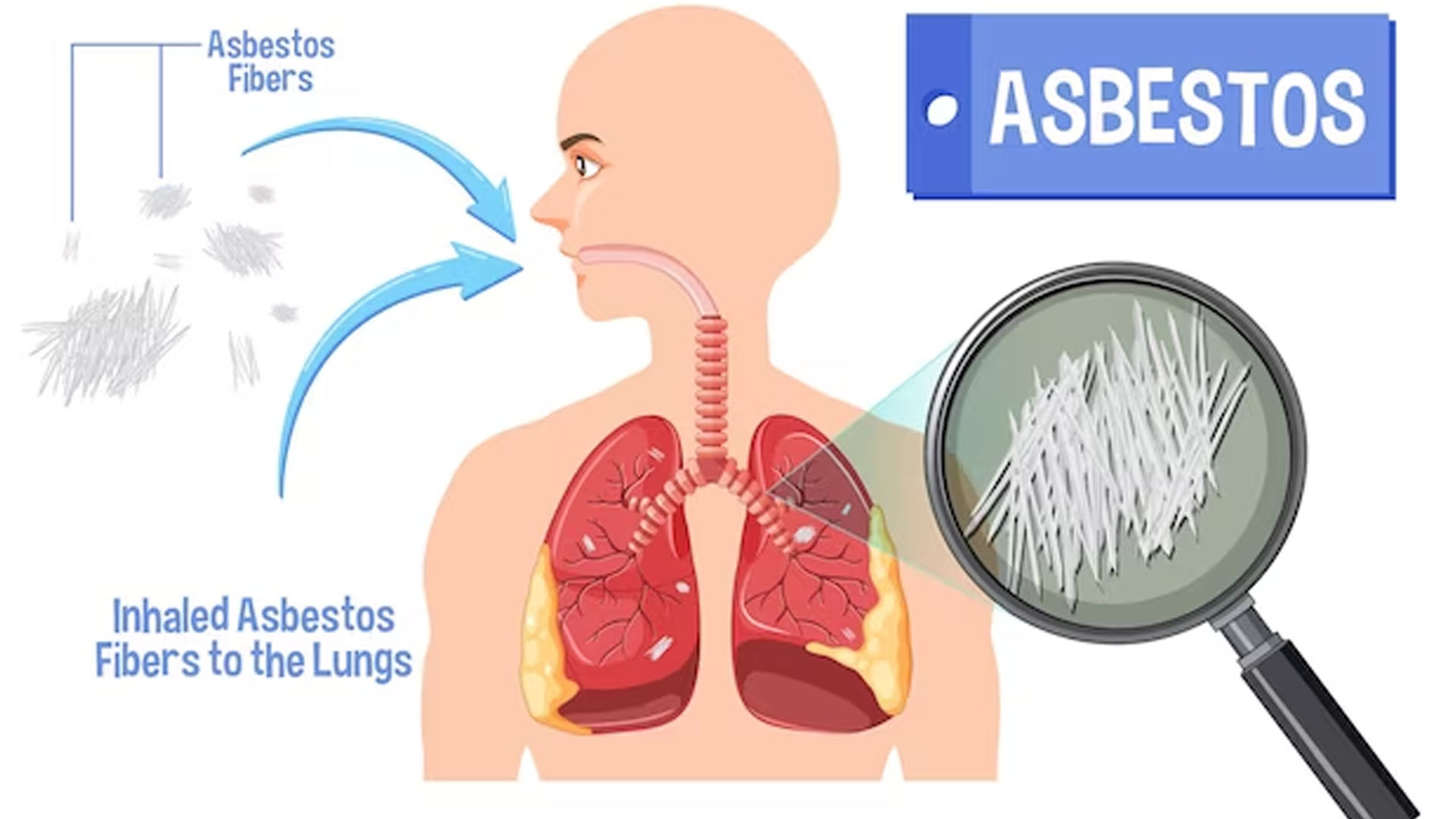 What are the Symptoms of Asbestos Cancer?