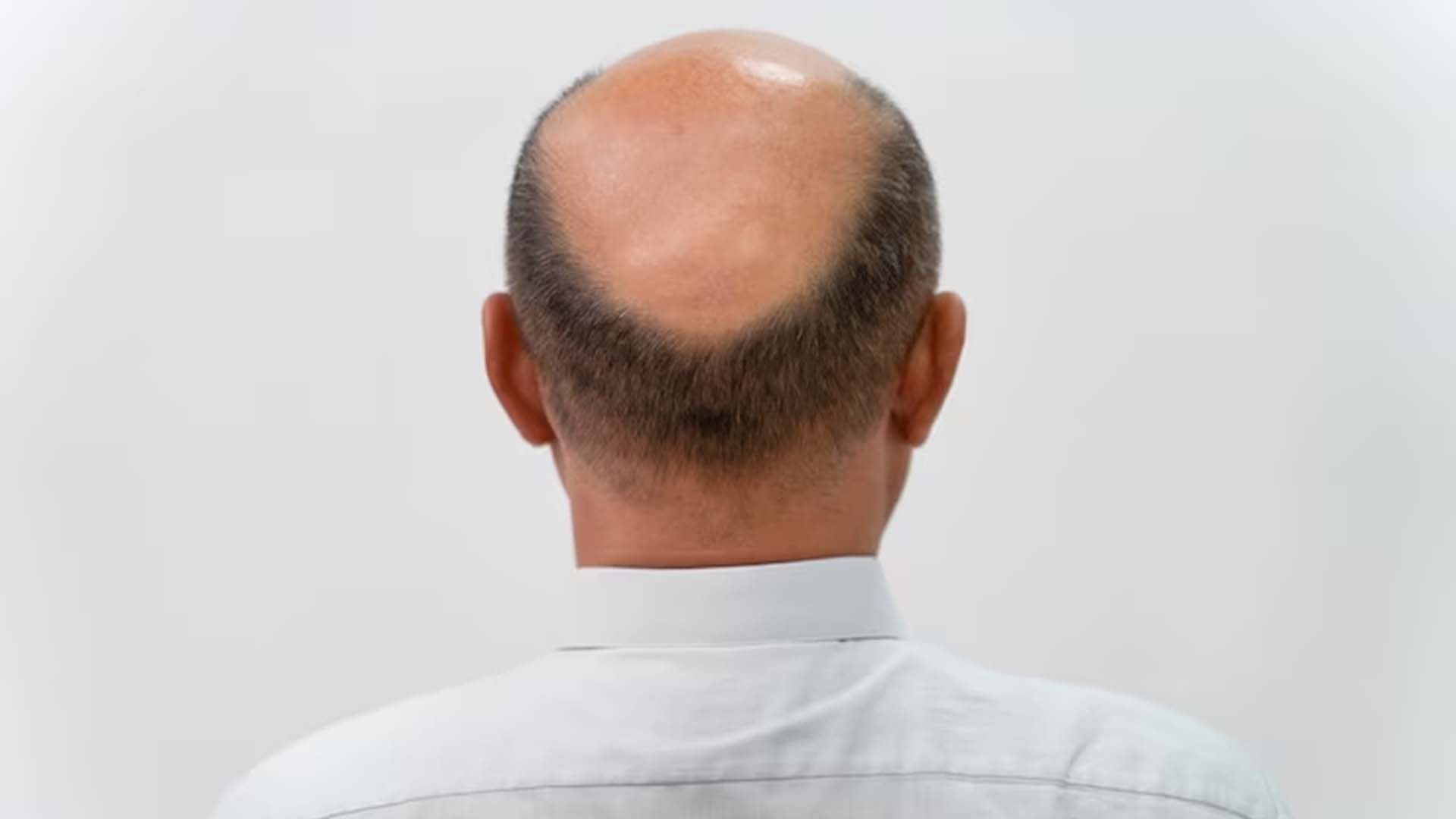 Baldness